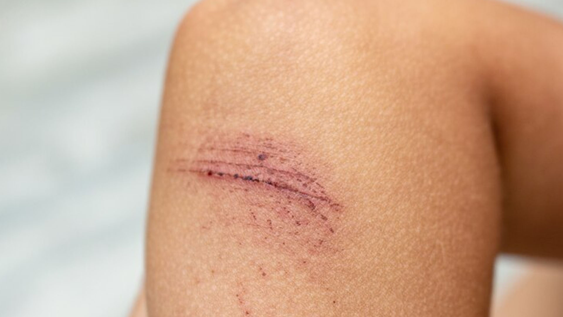 What are the Home Remedies for Hypertrophic Scars?