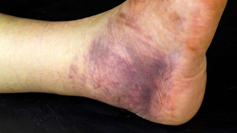 What Causes Internal Bleeding? – NutritionFact.in