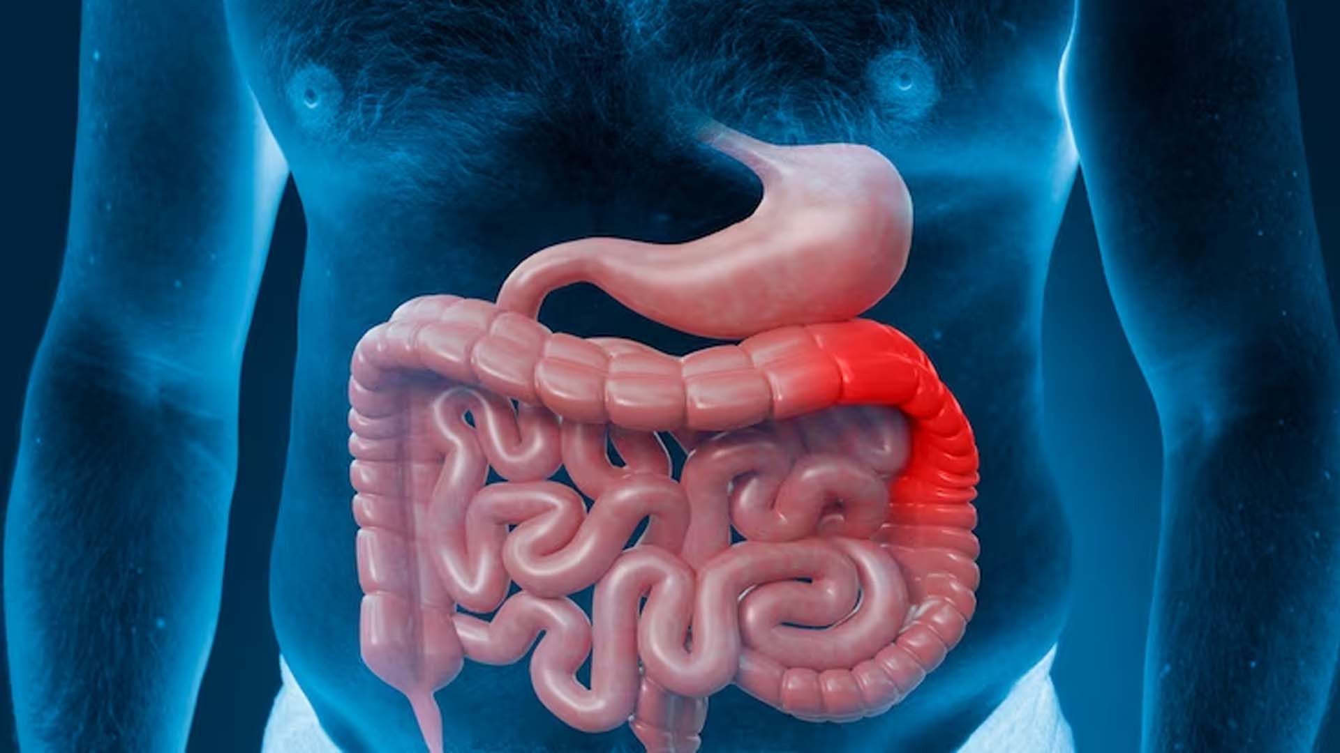 Intestinal ischemia