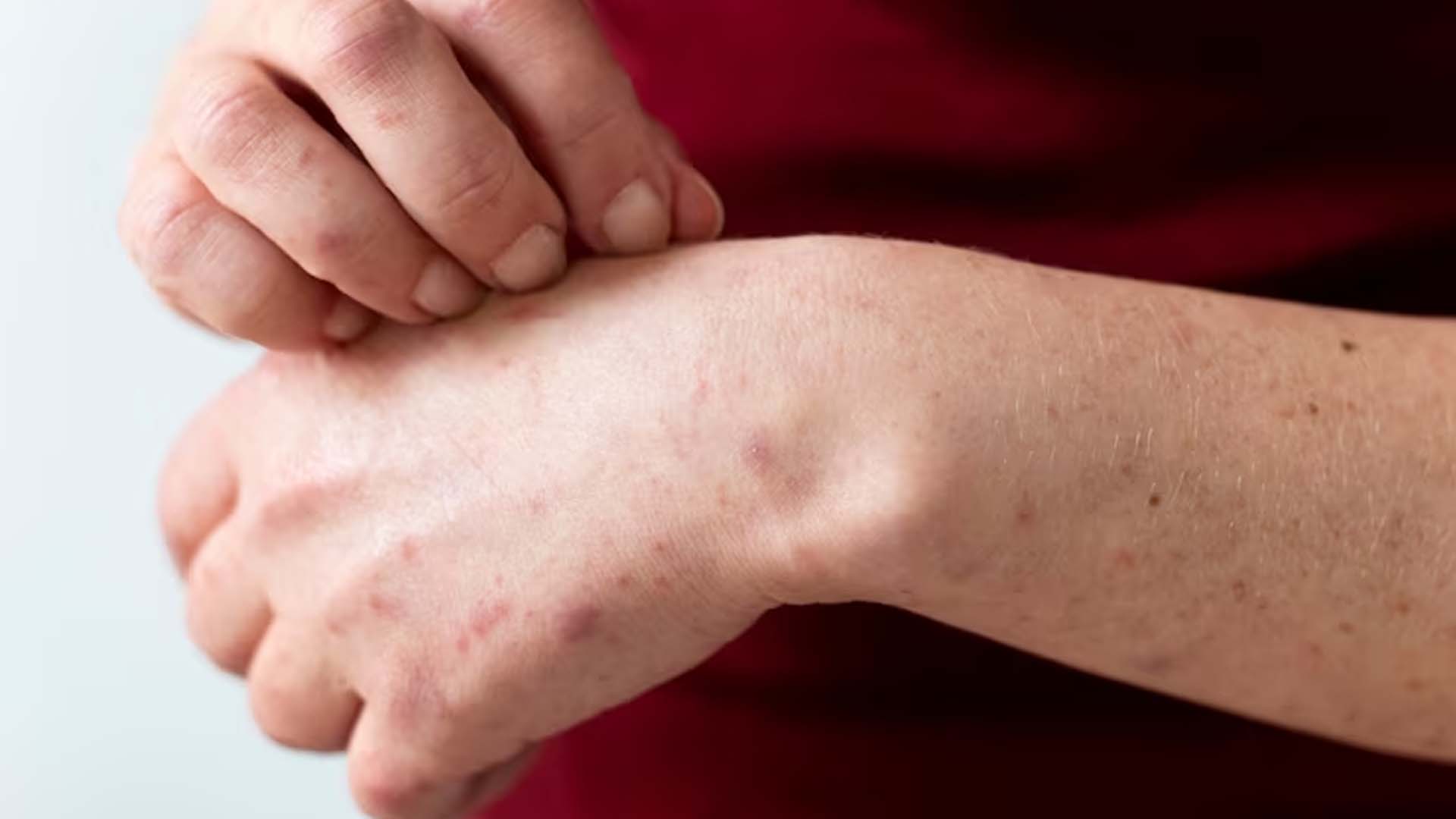 Itchy Skin and Red Spots