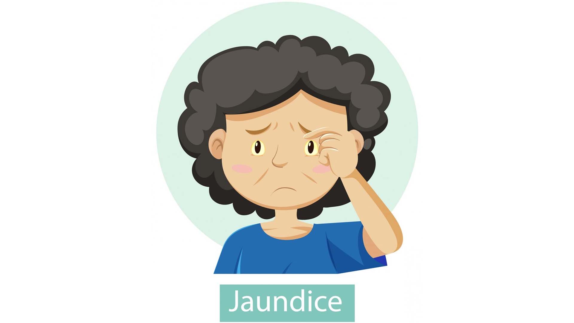 Jaundice