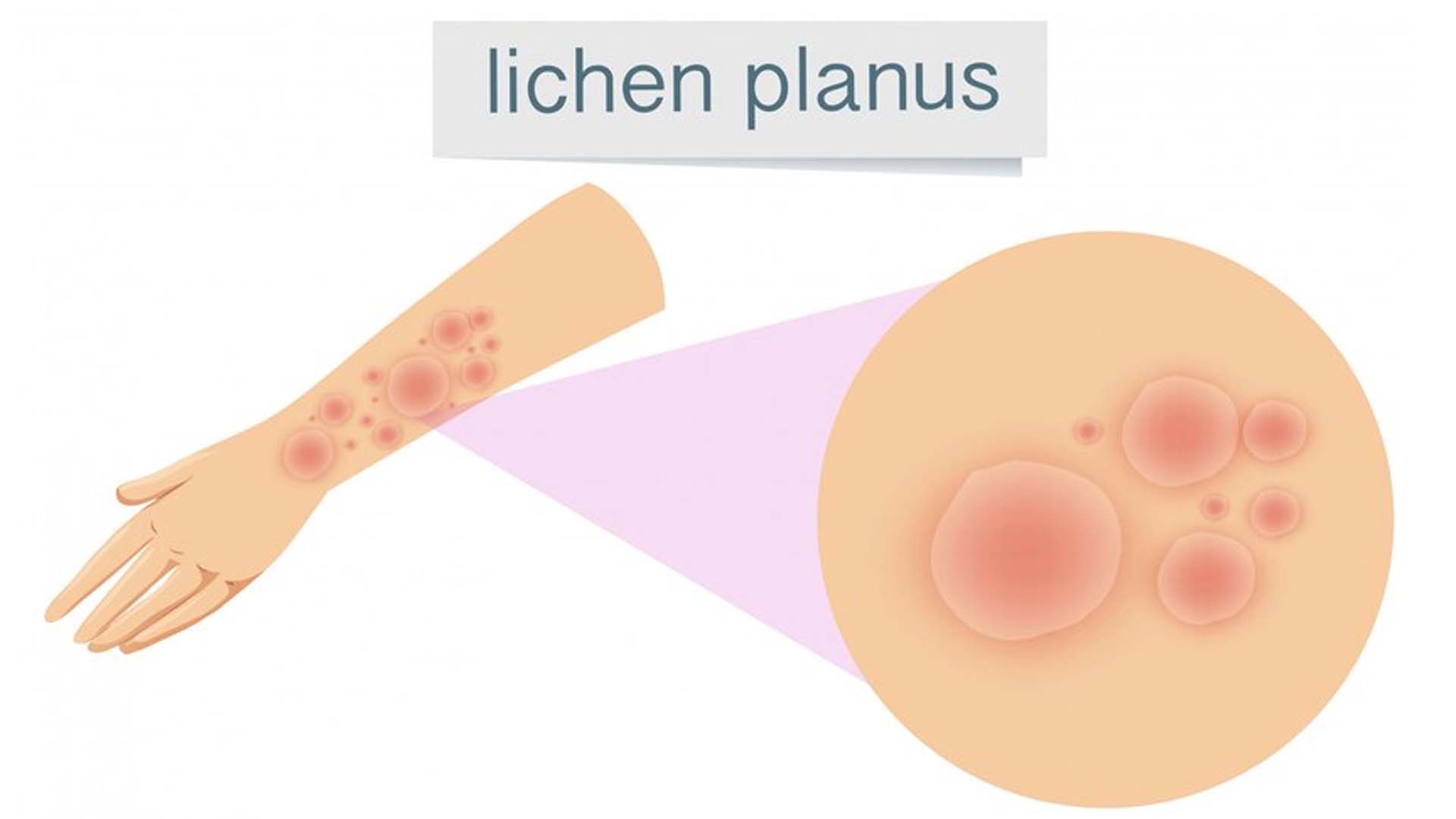 Lichen planus