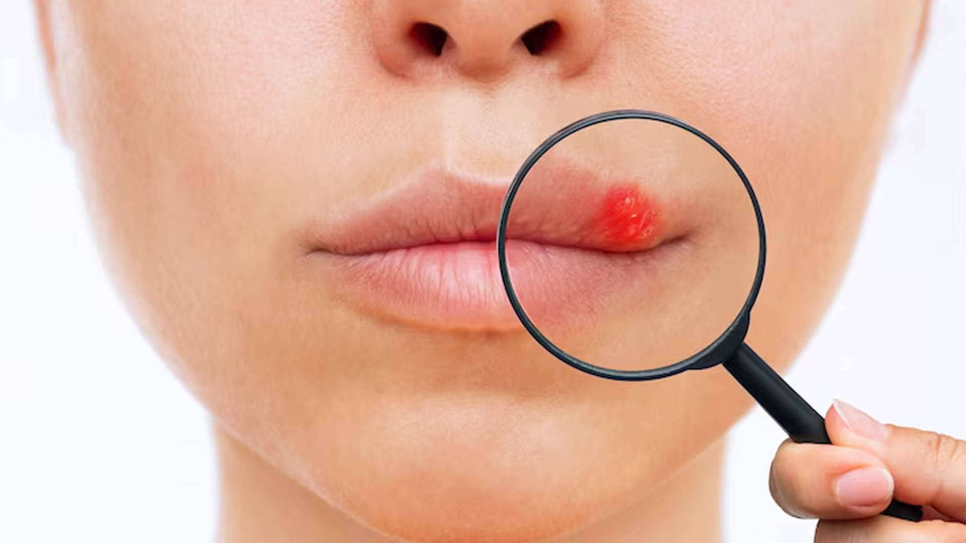 What are the Home Remedies for Lip Allergy?