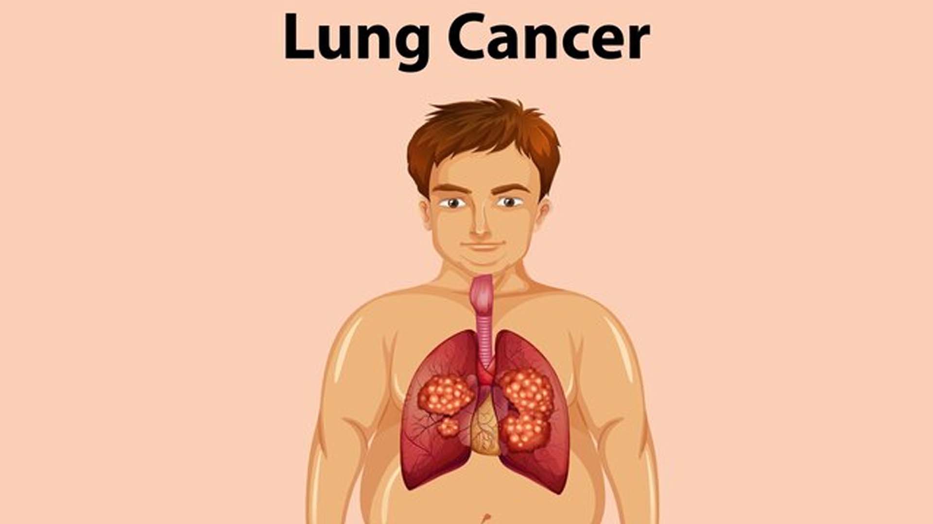 Lung Cancer