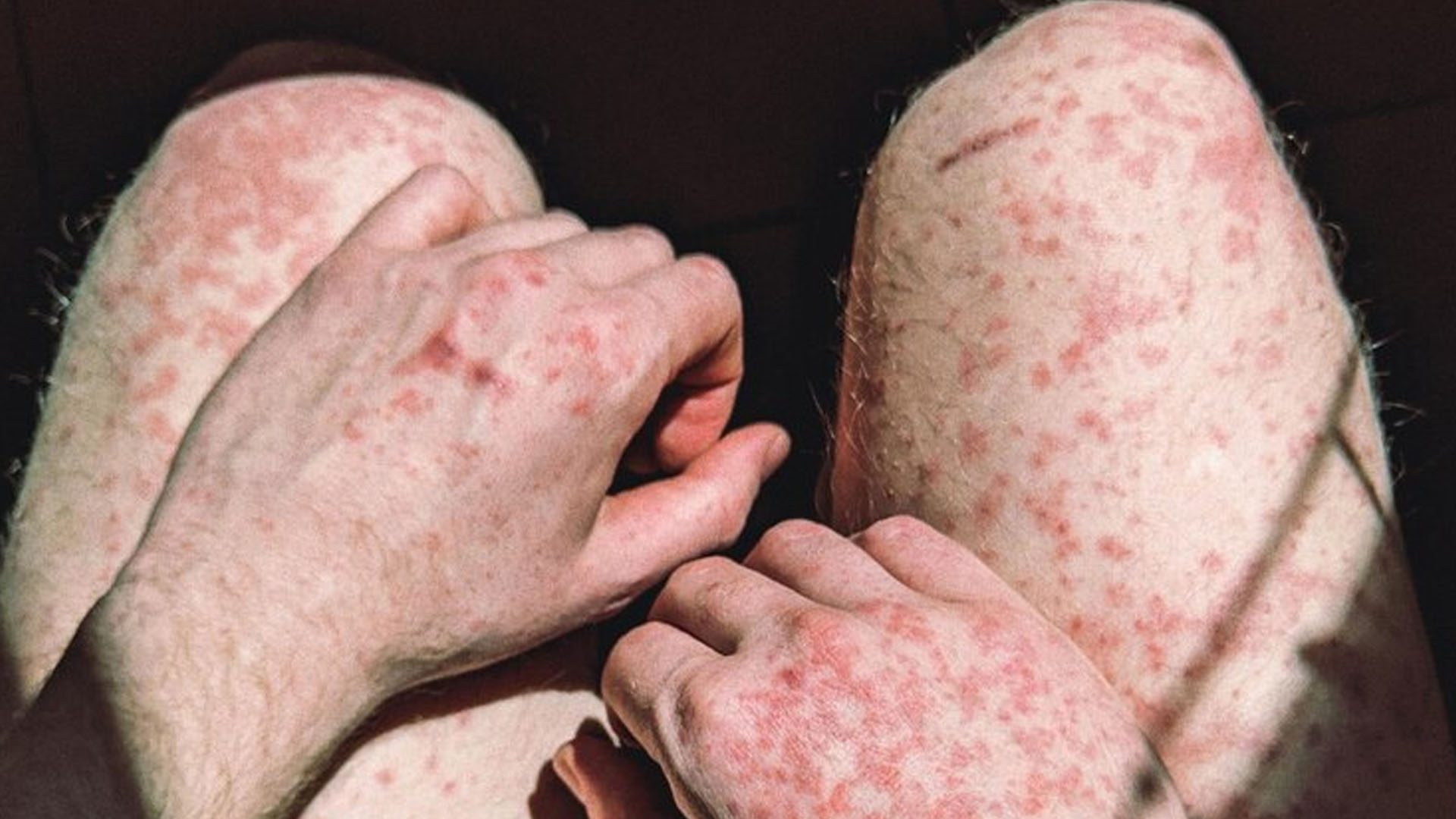 What are the Home Remedies for Measles?