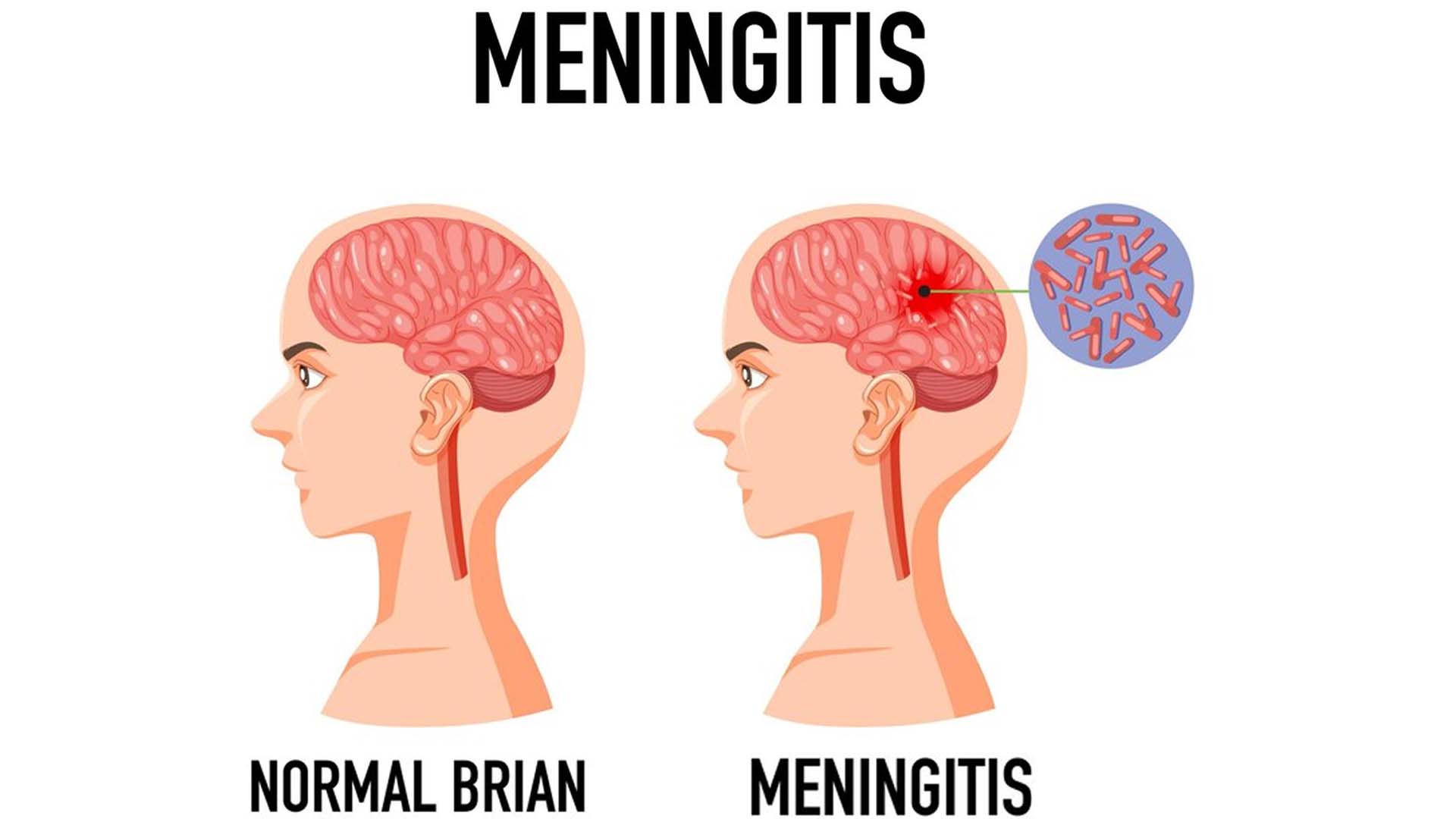 Meningitis