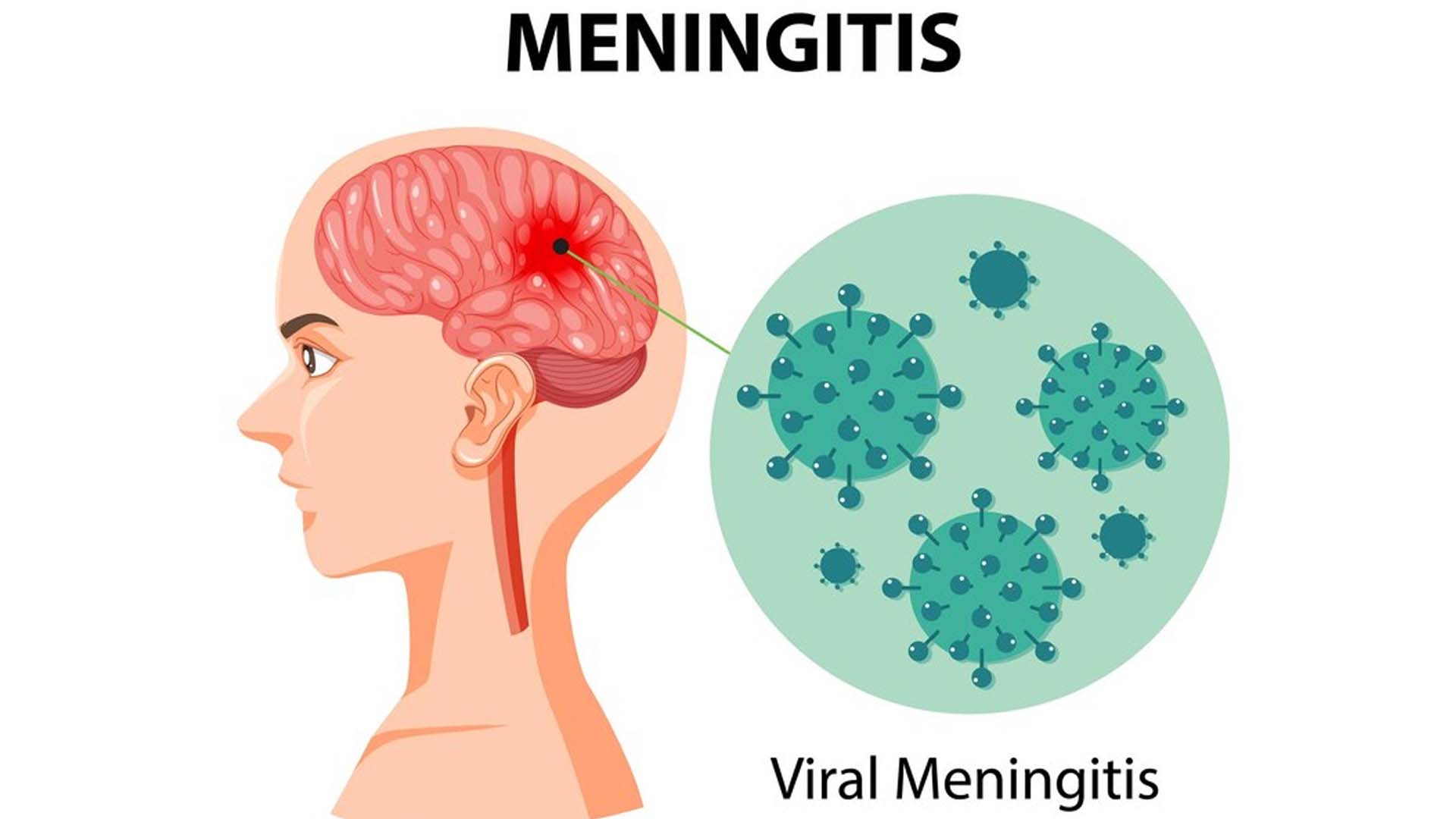 Meningitis