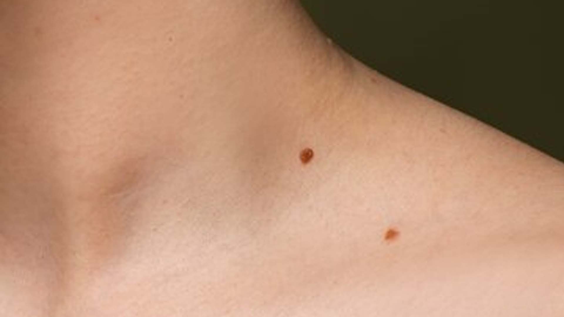 Moles on the Human Body