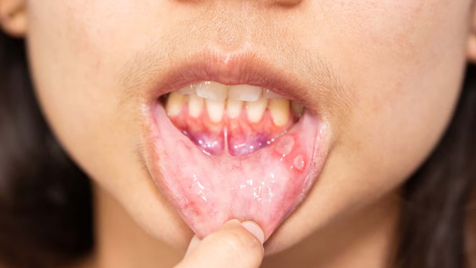 Canker sores or Aphthous ulcers