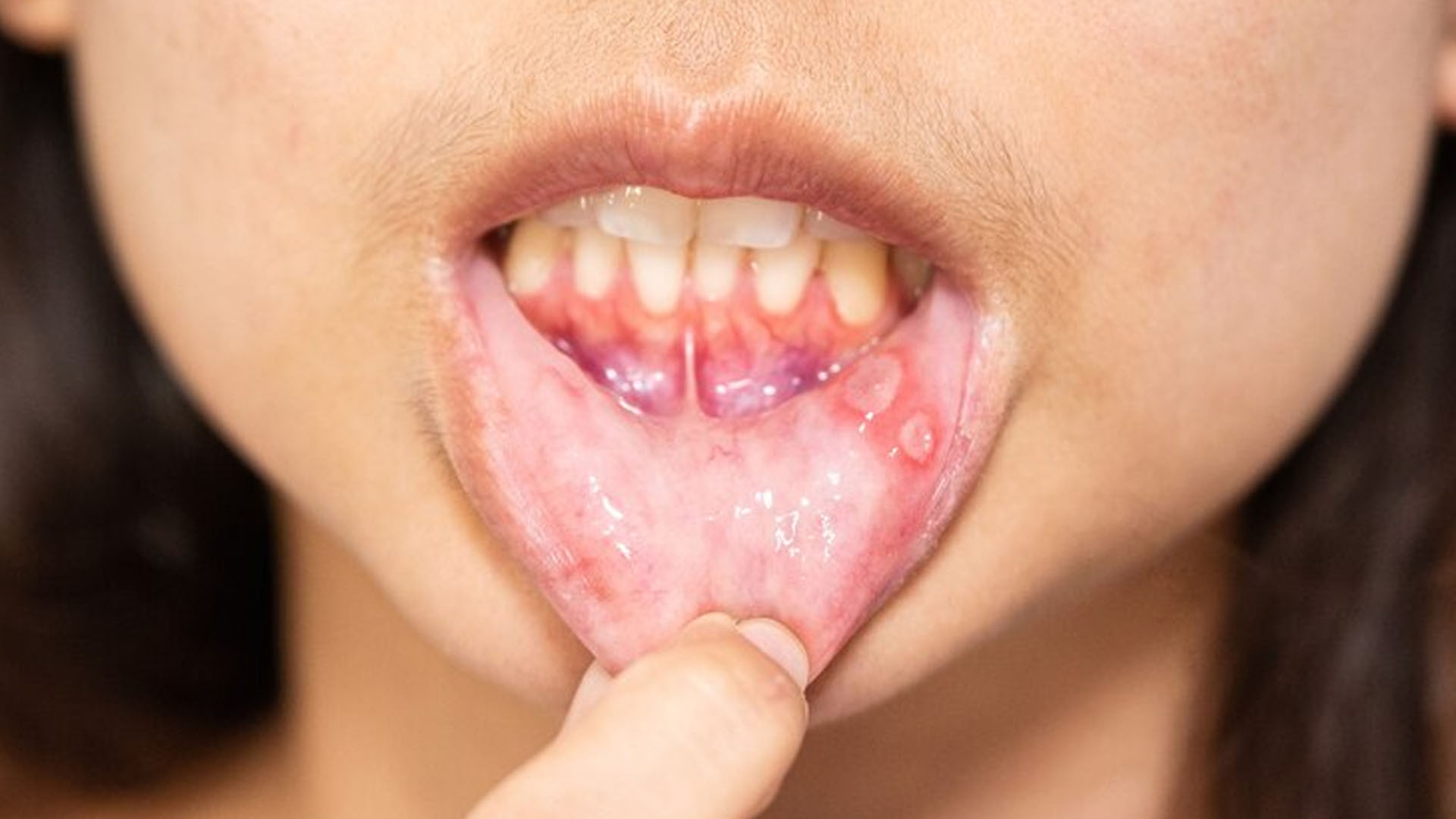 What are the Home Remedies for Mouth Fibrosis?