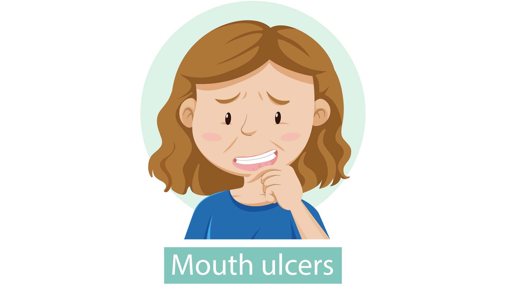 Mouth Ulcers in Kids