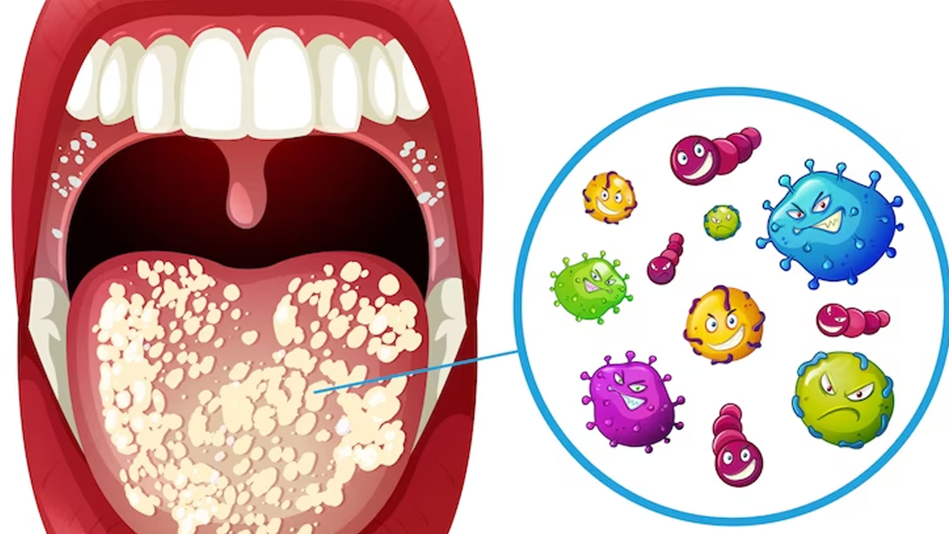 What are the Home Remedies for Oral Thrush?