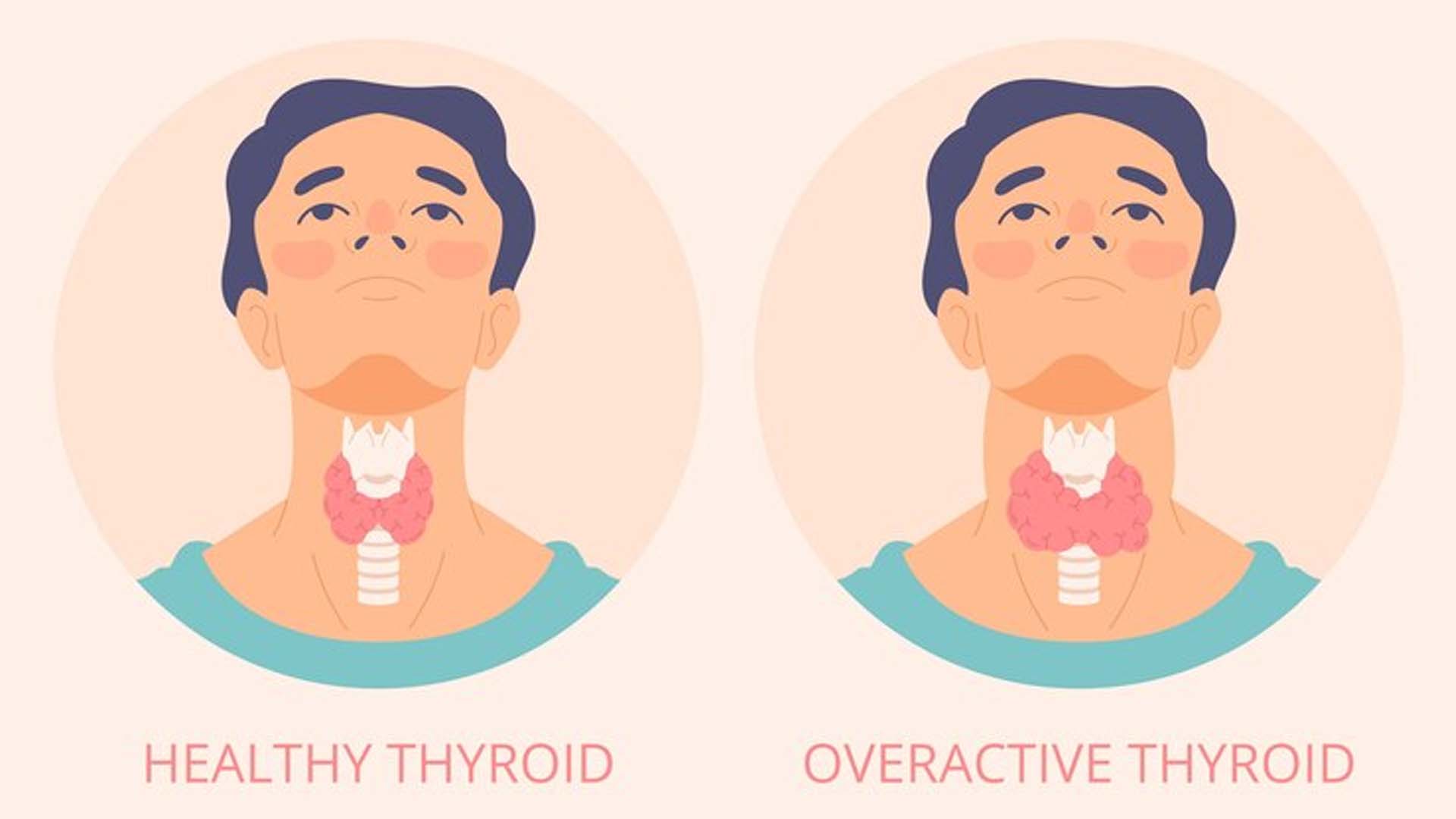 Overactive Thyroid