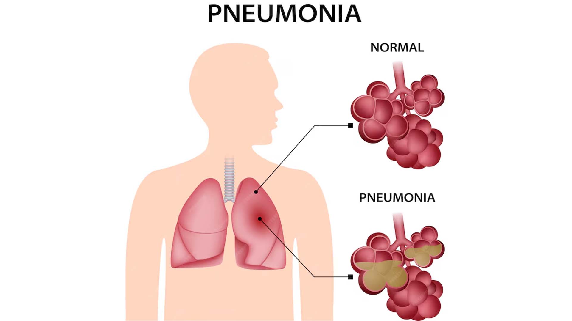 Pneumonia