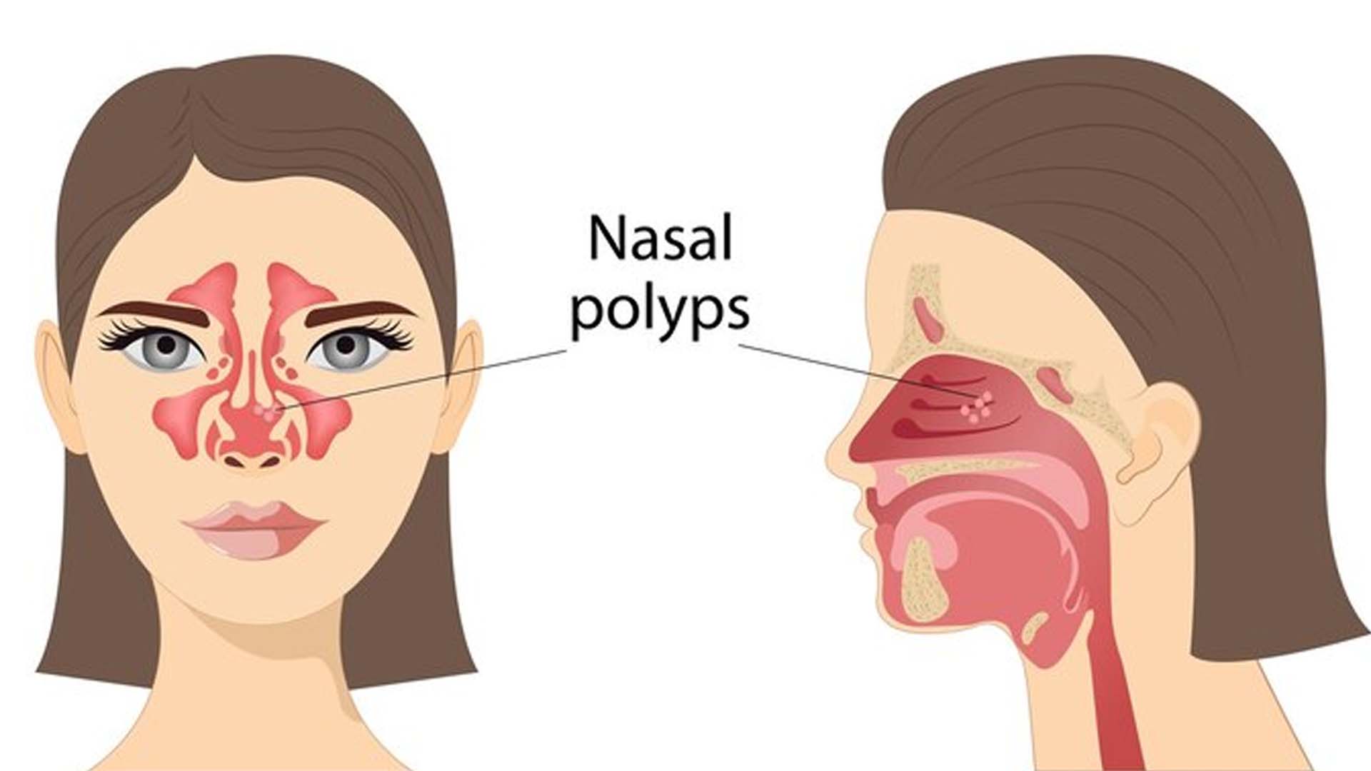 Nasal polyps