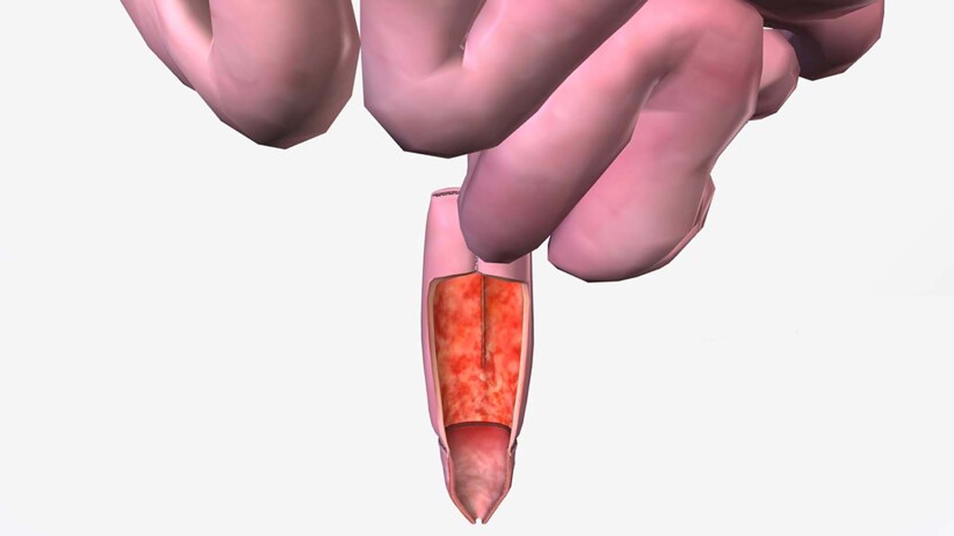 Pouchitis