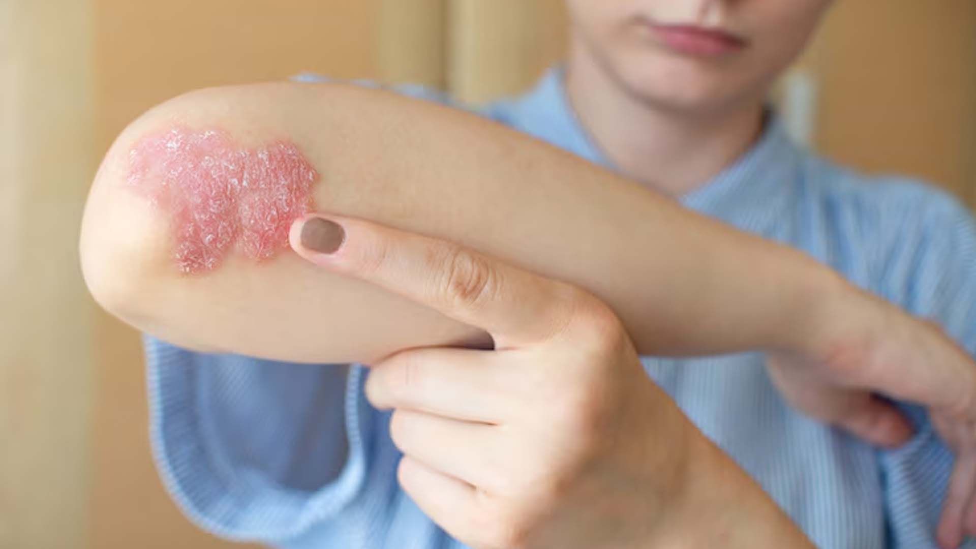 Psoriasis