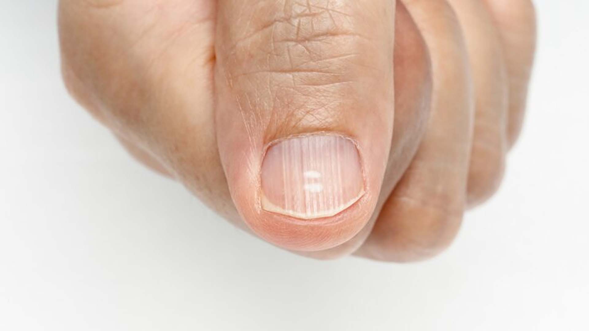 White Lines on Nails