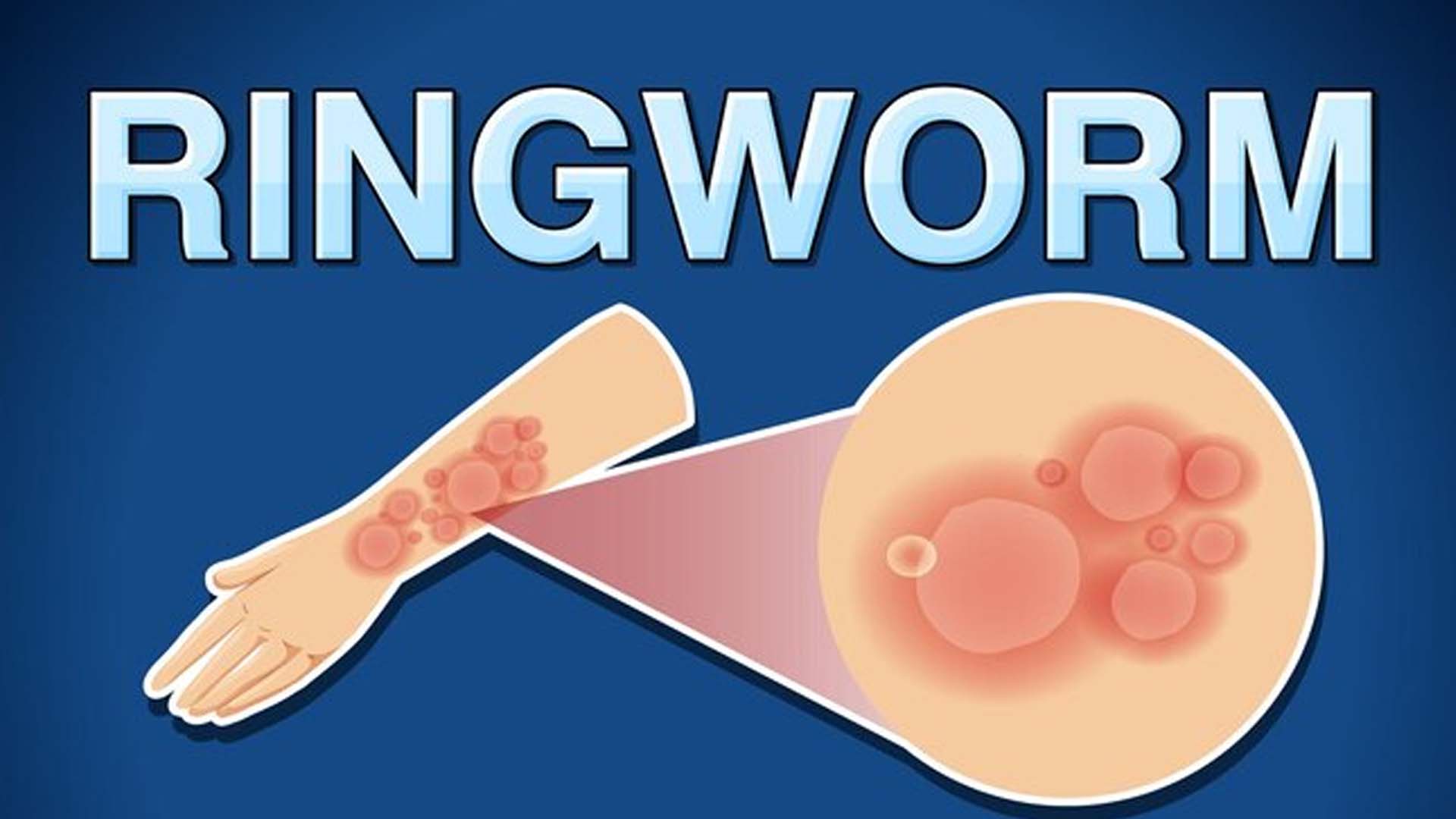 Ringworm