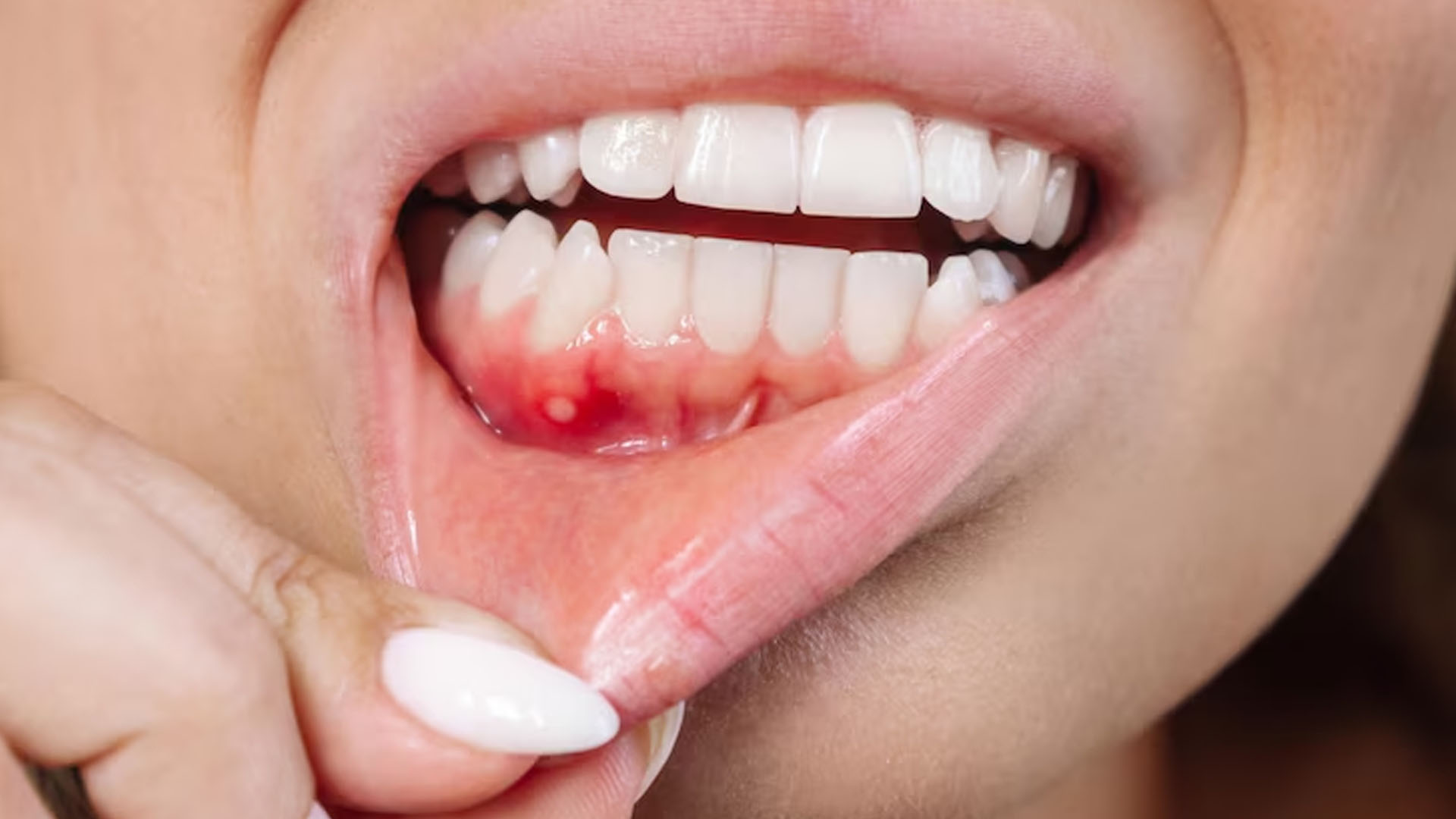 What are the Home Remedies for Removing Tartar from Teeth?