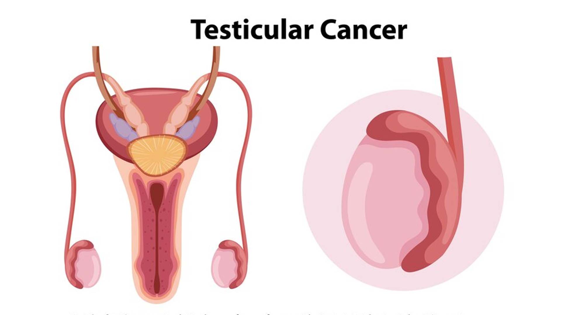 Testicular Cancer