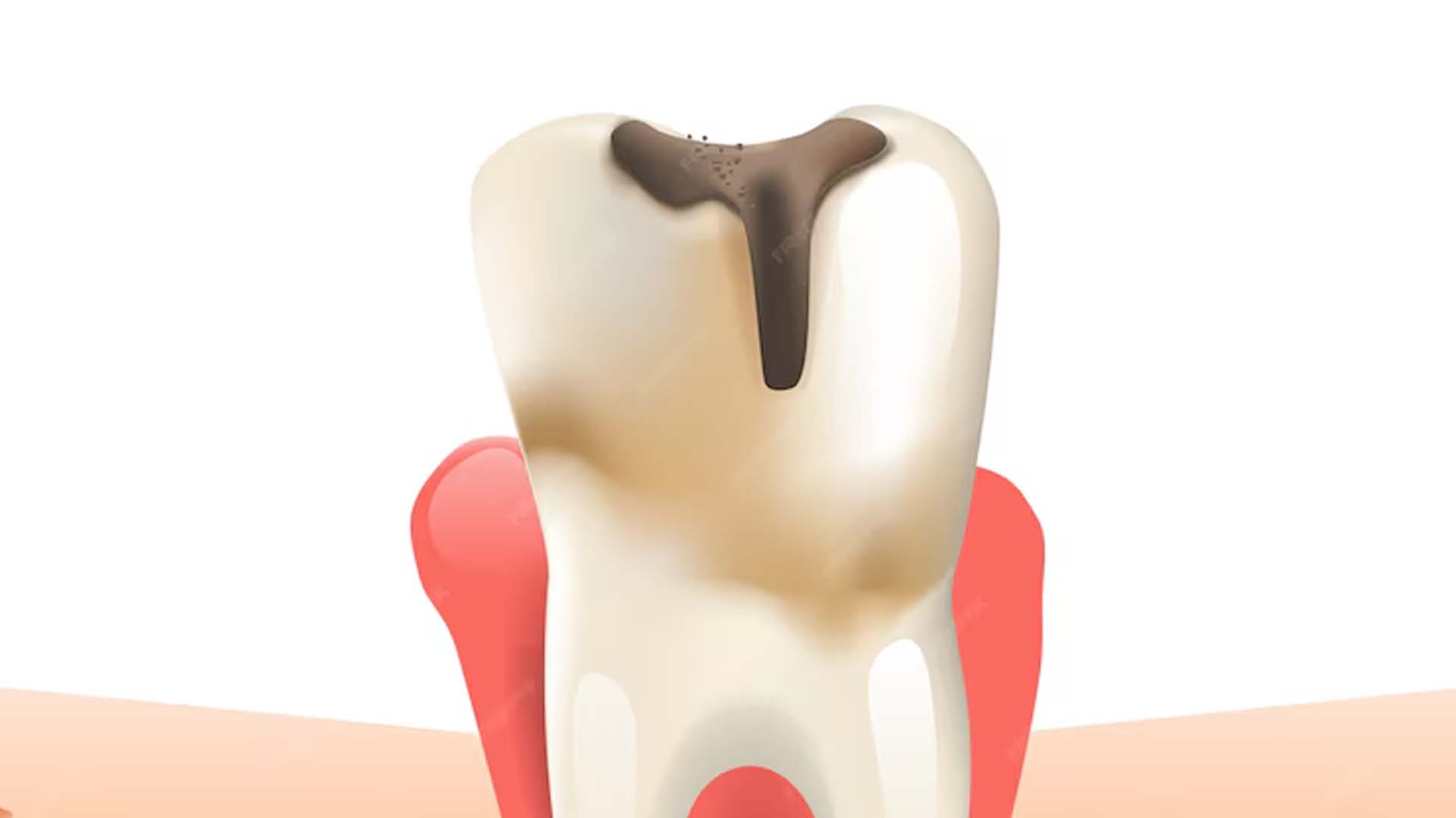 Dental Caries or Cavities