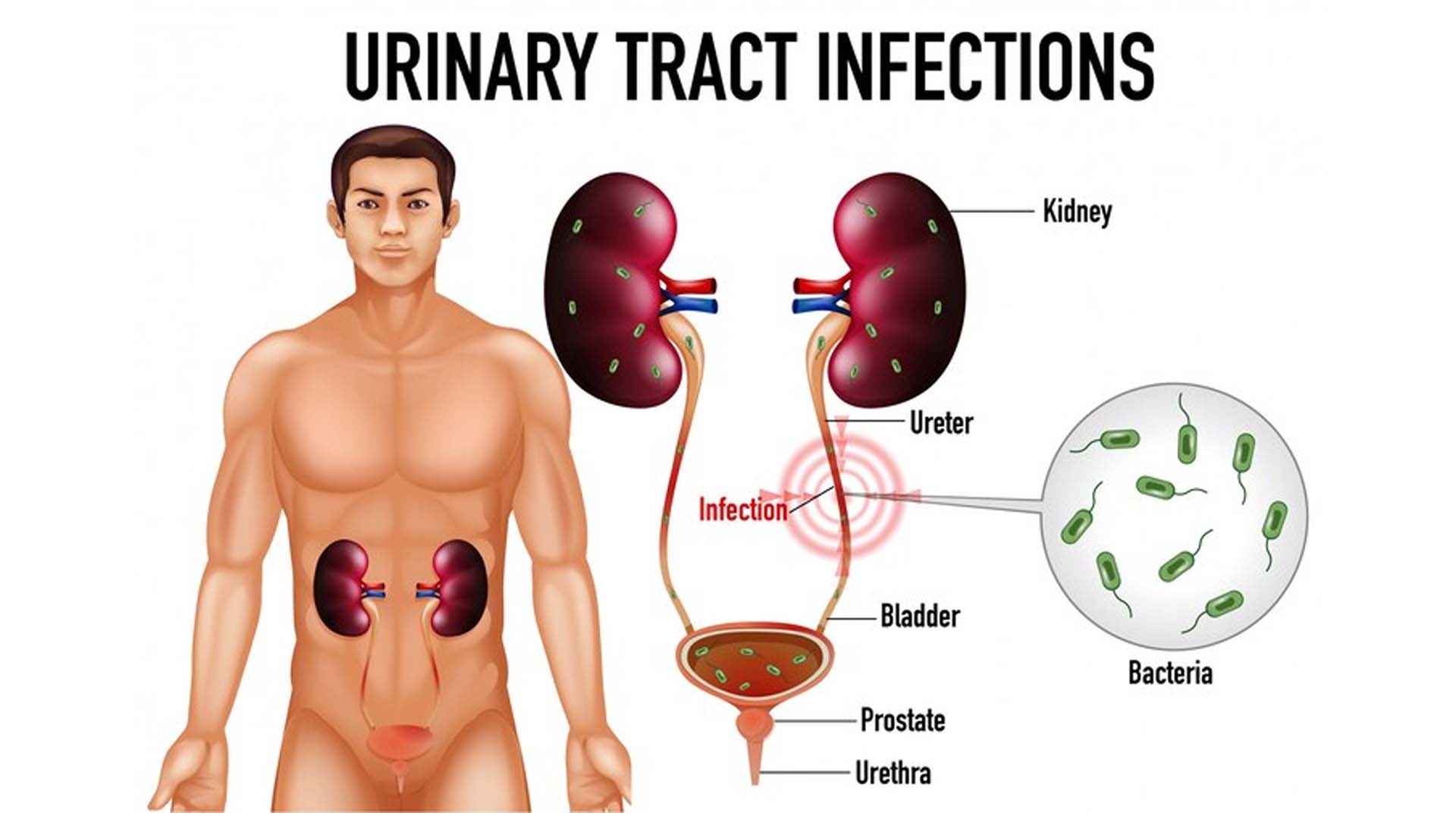 Urinary tract infections (UTIs)