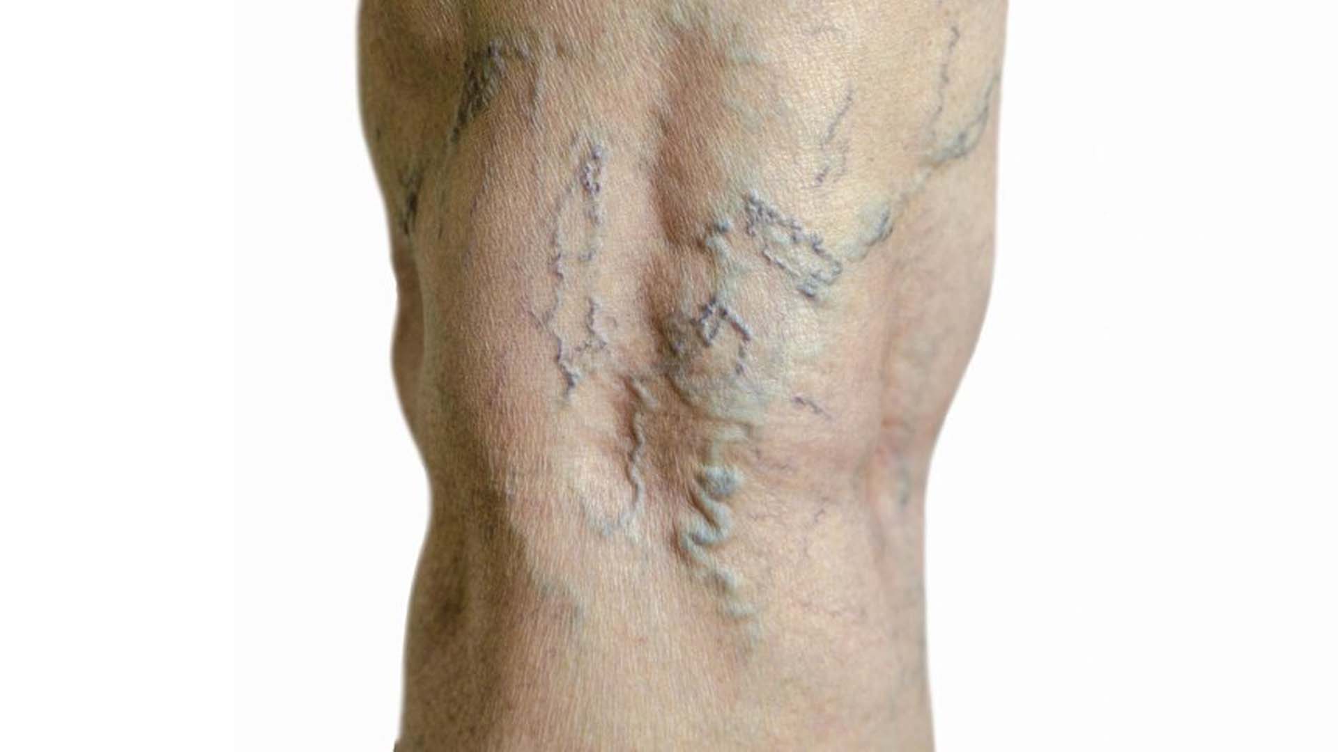 Varicose Veins