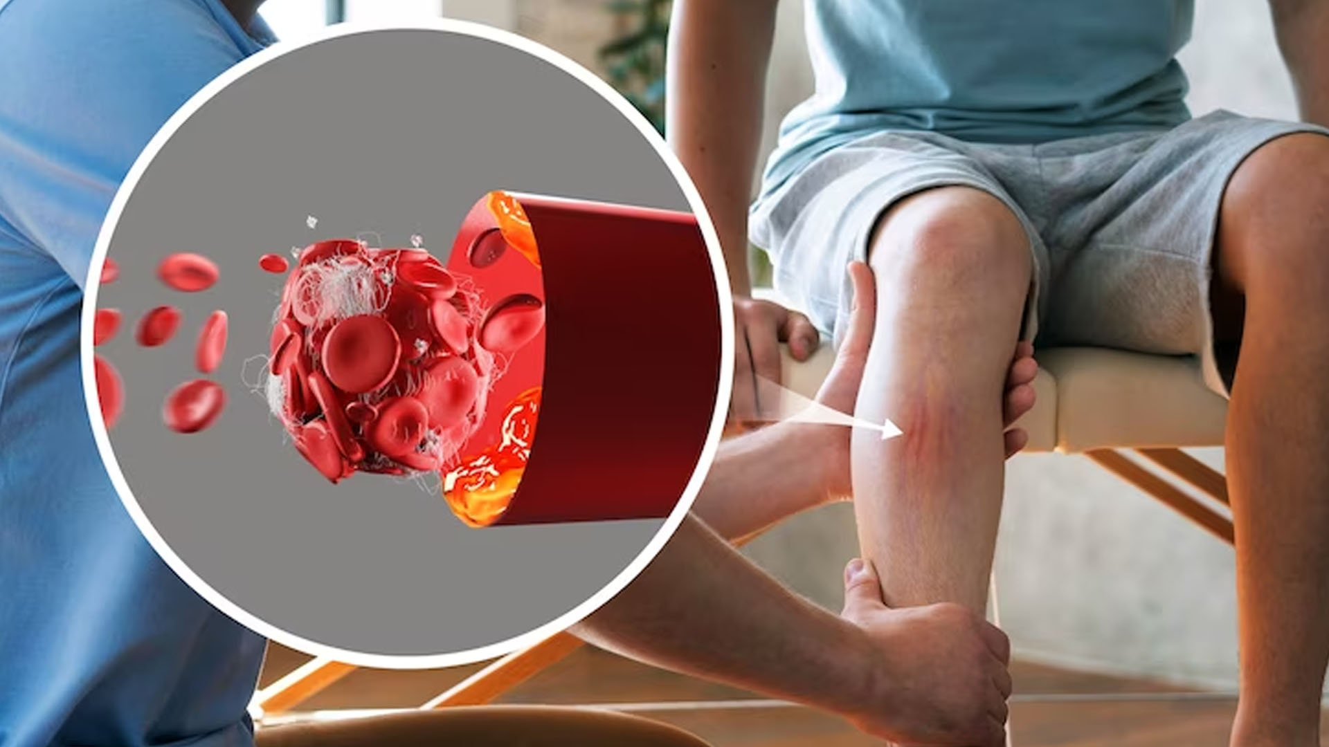 What are the Home Remedies to get relief from Varicose Vein pain?