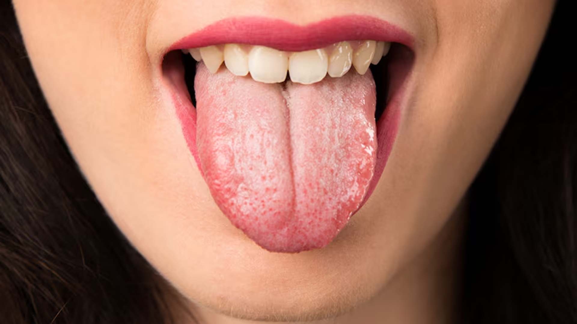 White Tongue or coated tongue or oral thrush