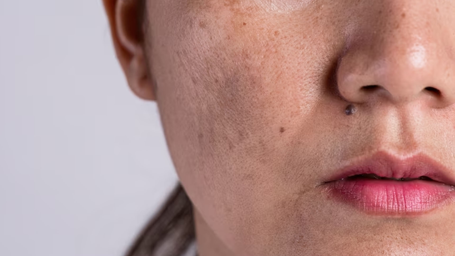 What are the Home Remedies for White Patches on Skin?