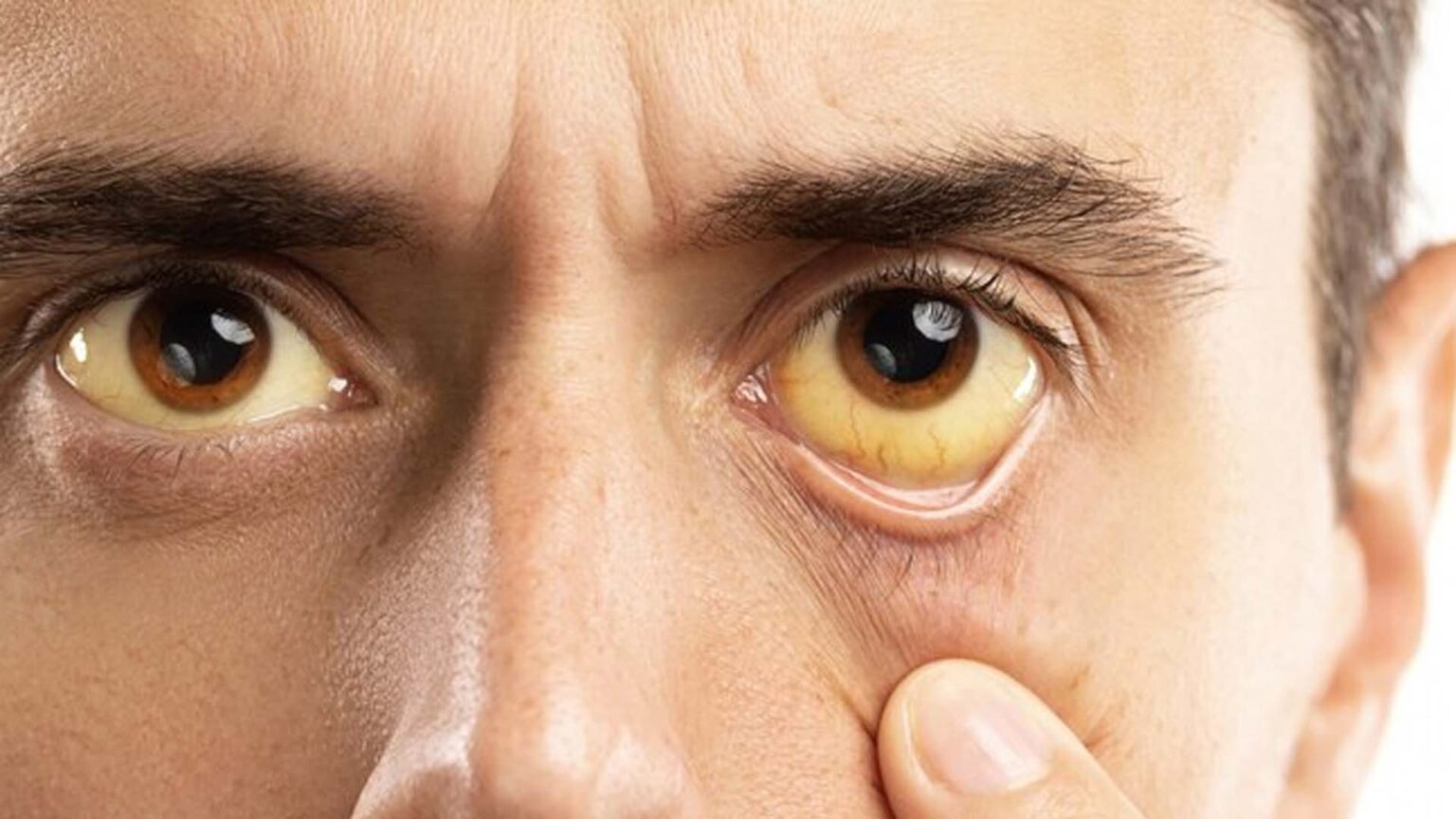 What Causes High Bilirubin Levels in Blood? NutritionFact.in