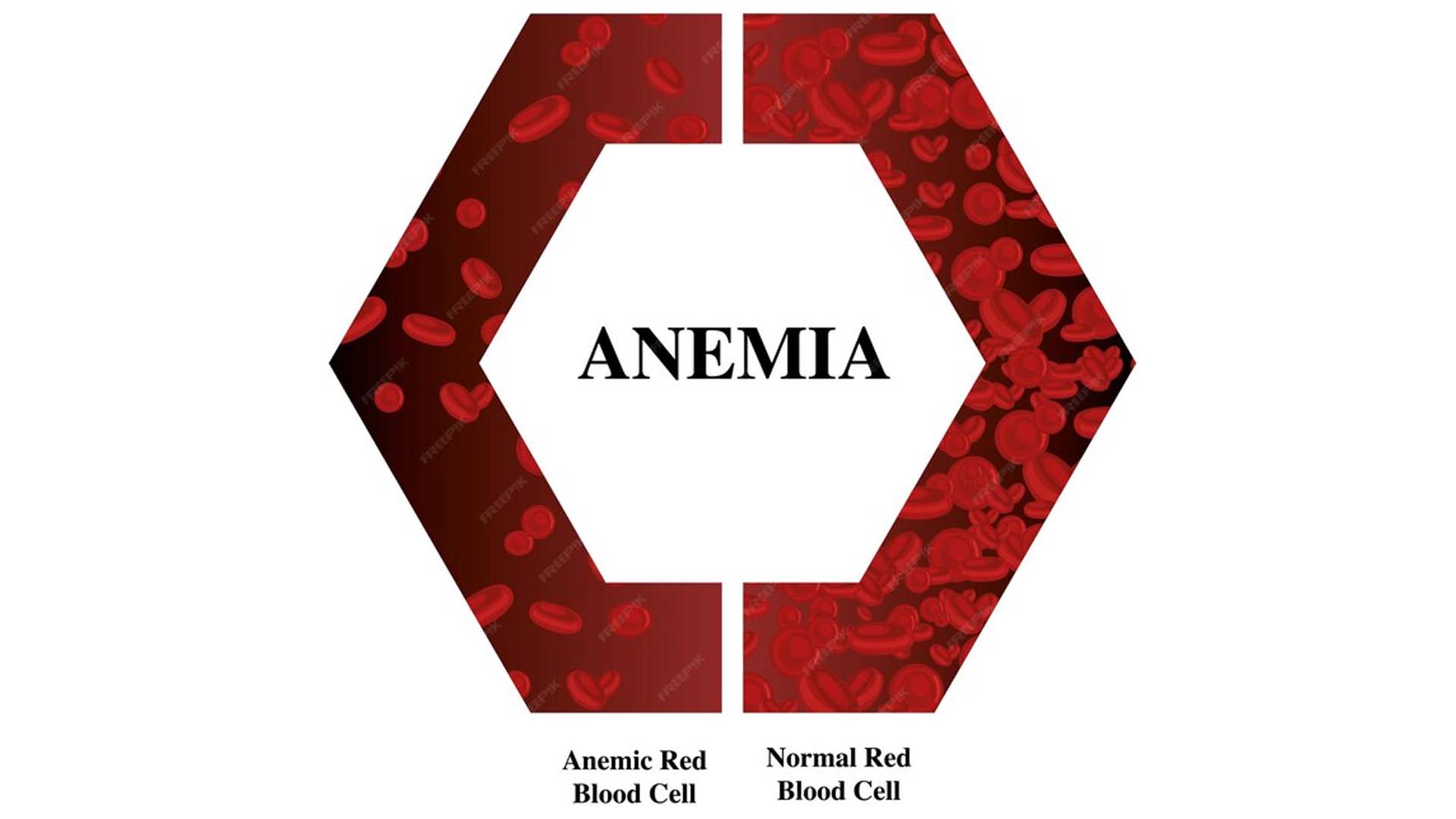 Anemia