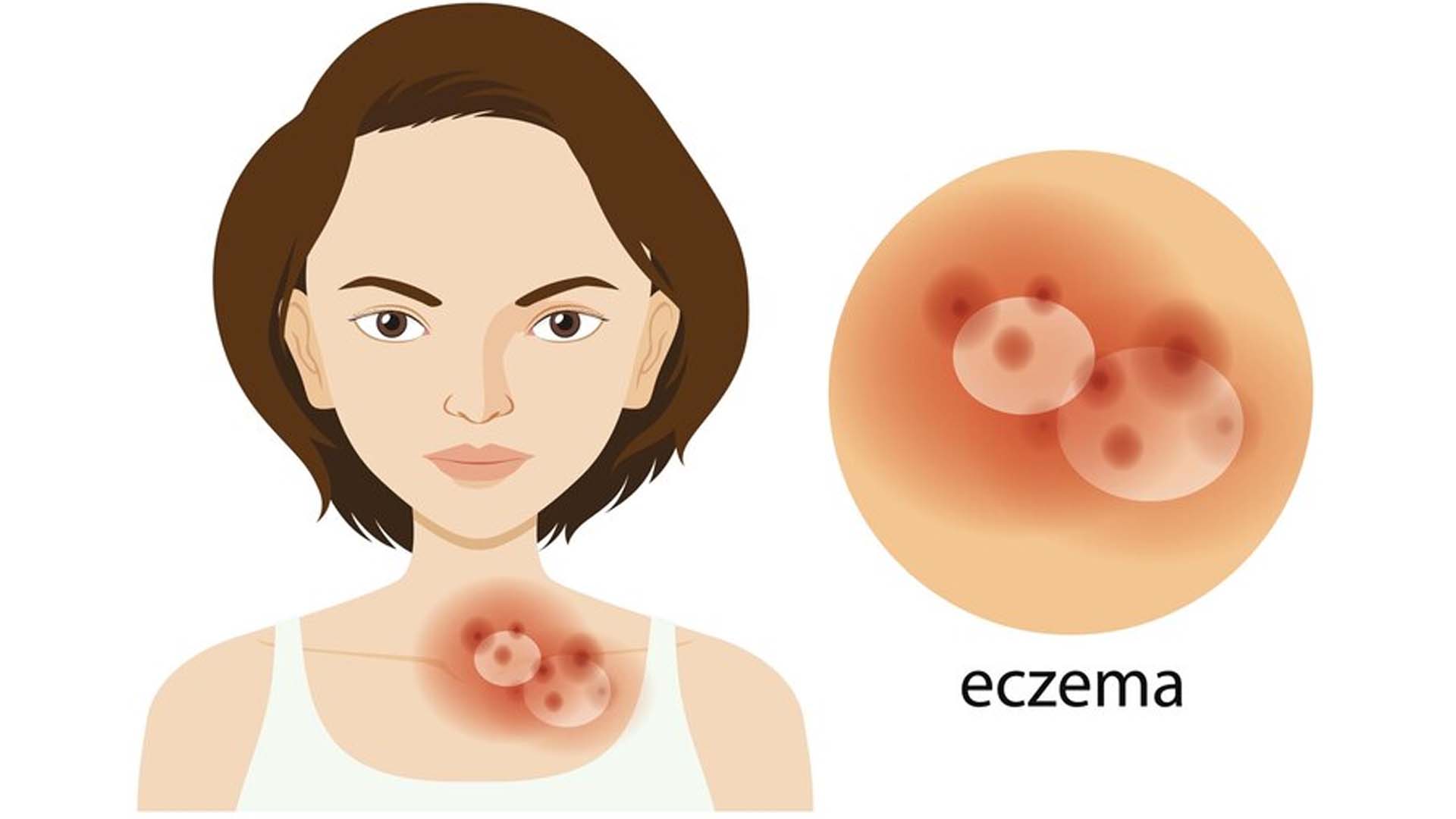 Eczema