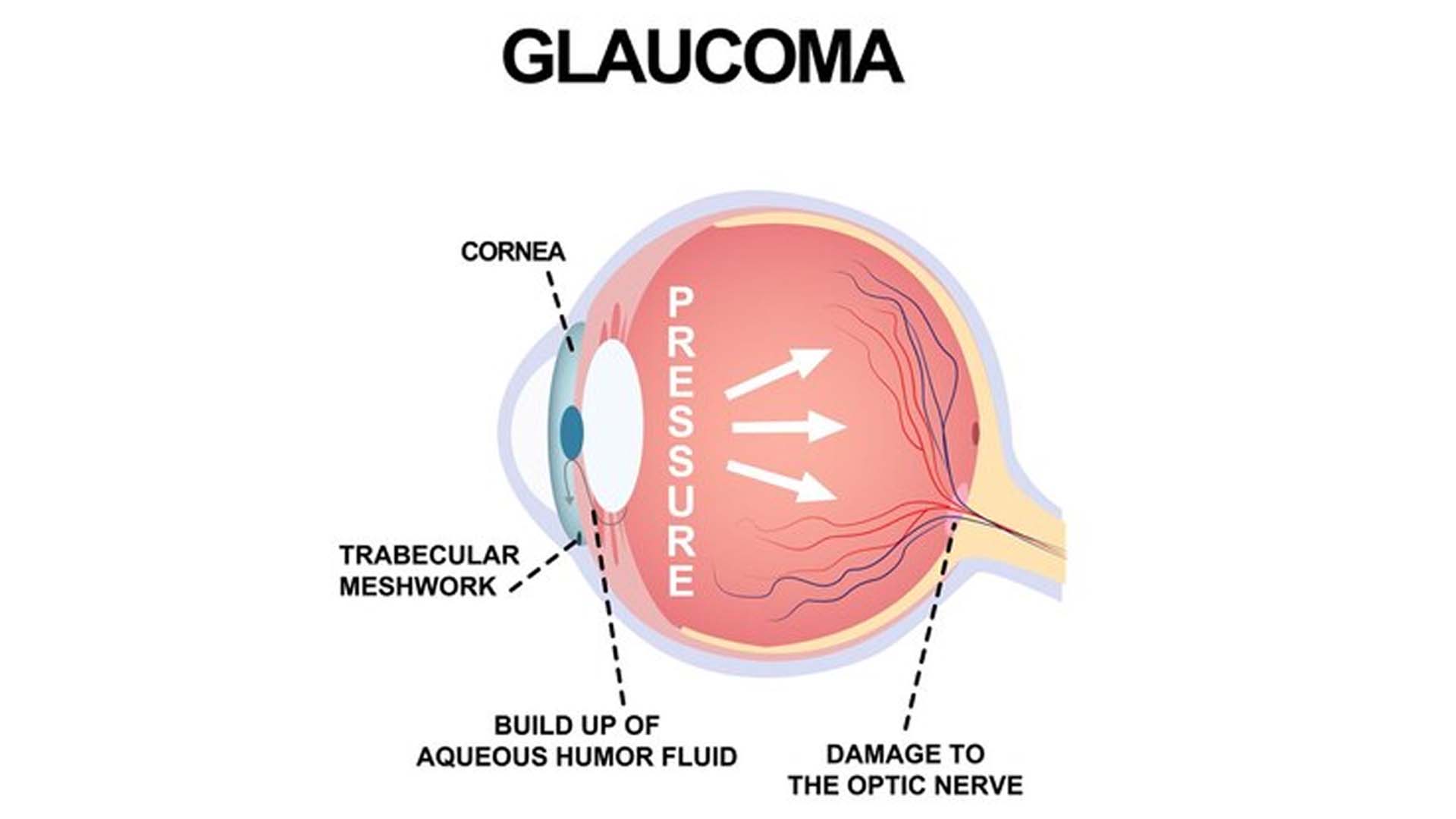 Glaucoma