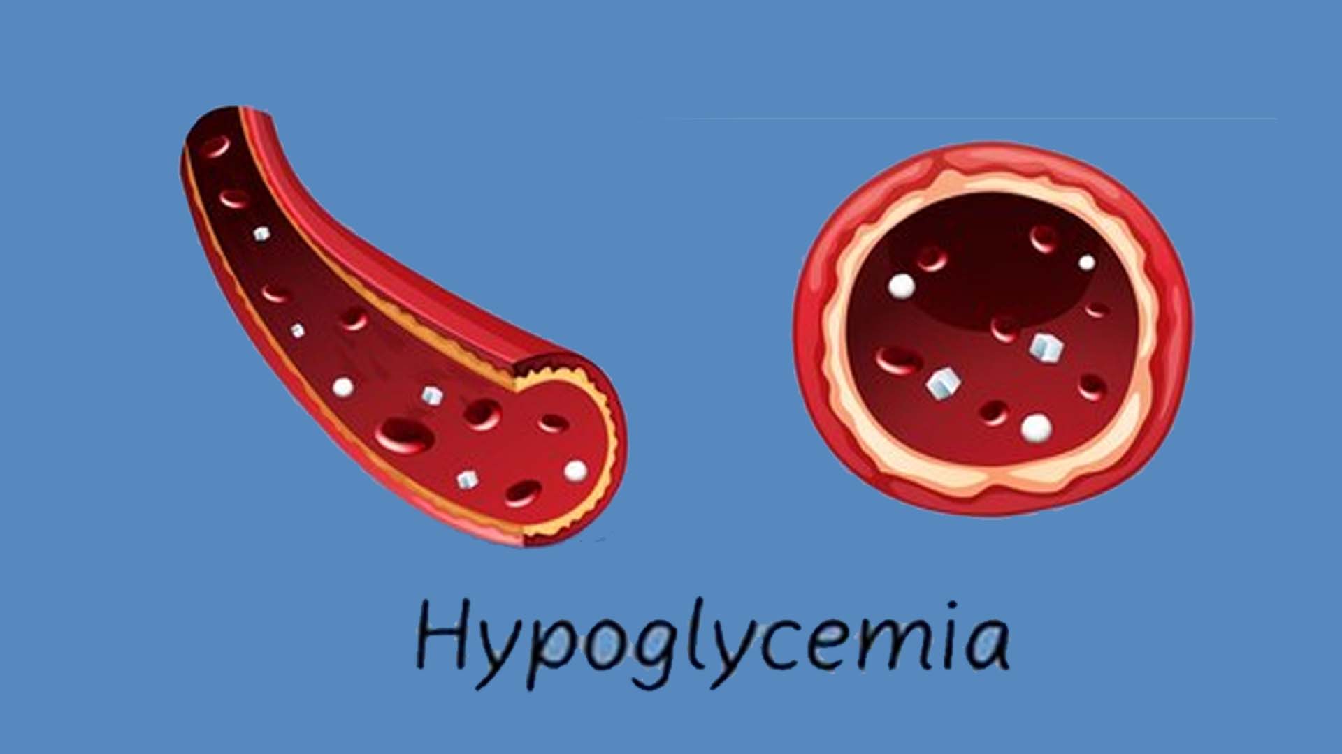 Hypoglycemia