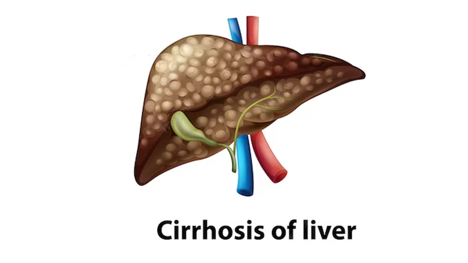 Liver Cirrhosis