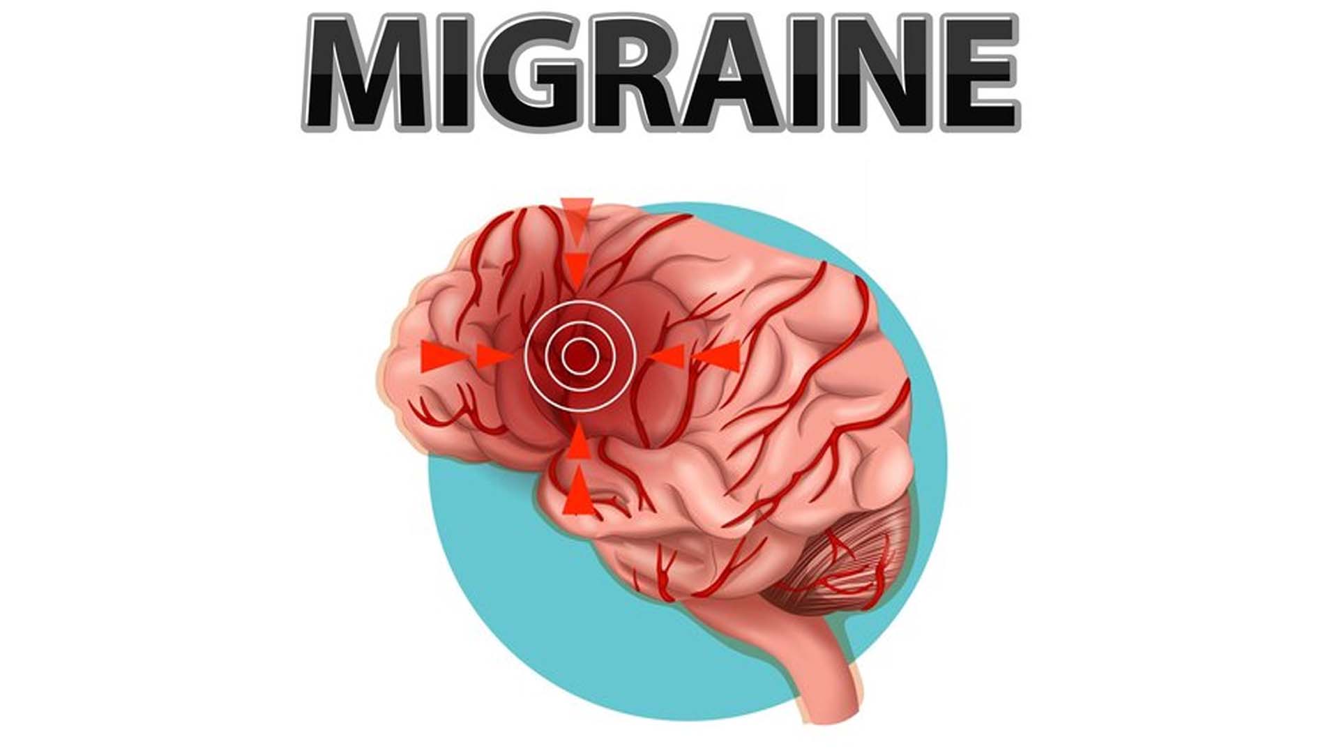 Migraine