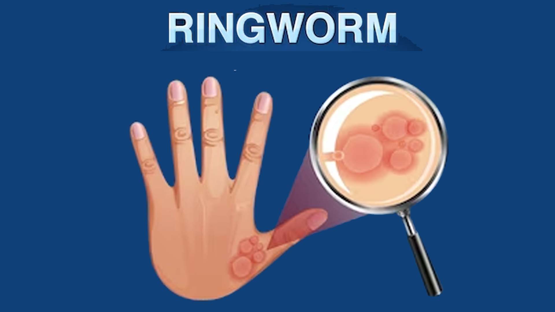 Ringworm