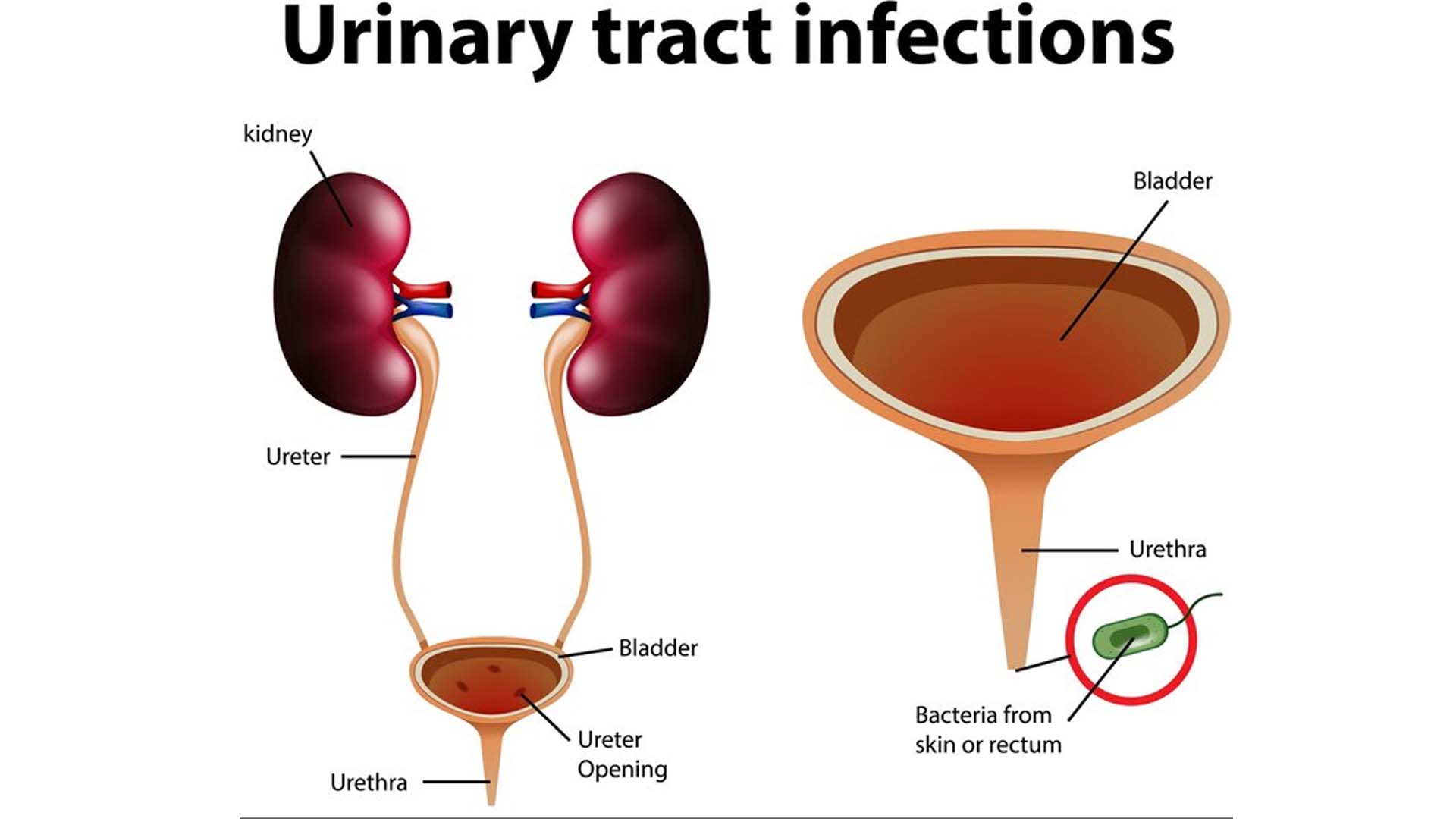 Urinary tract infections (UTIs)