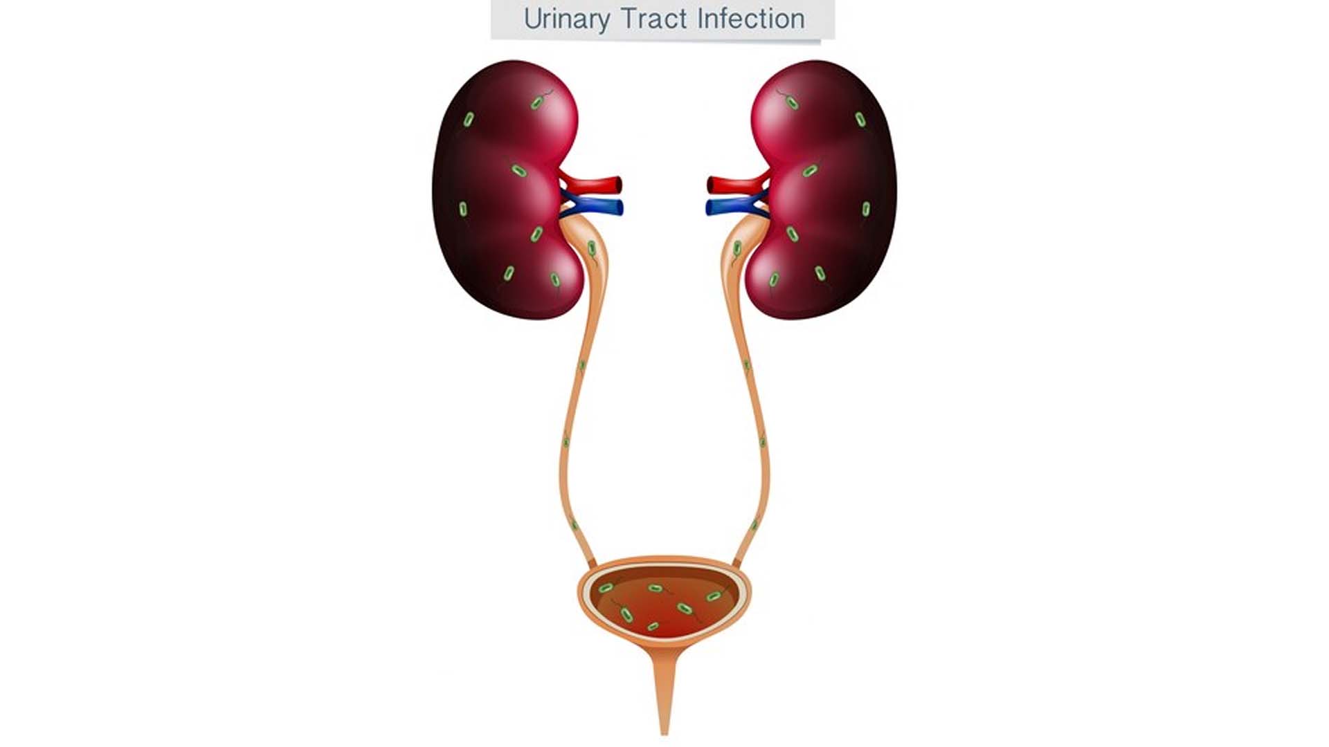 Urinary Tract Infection (UTI)