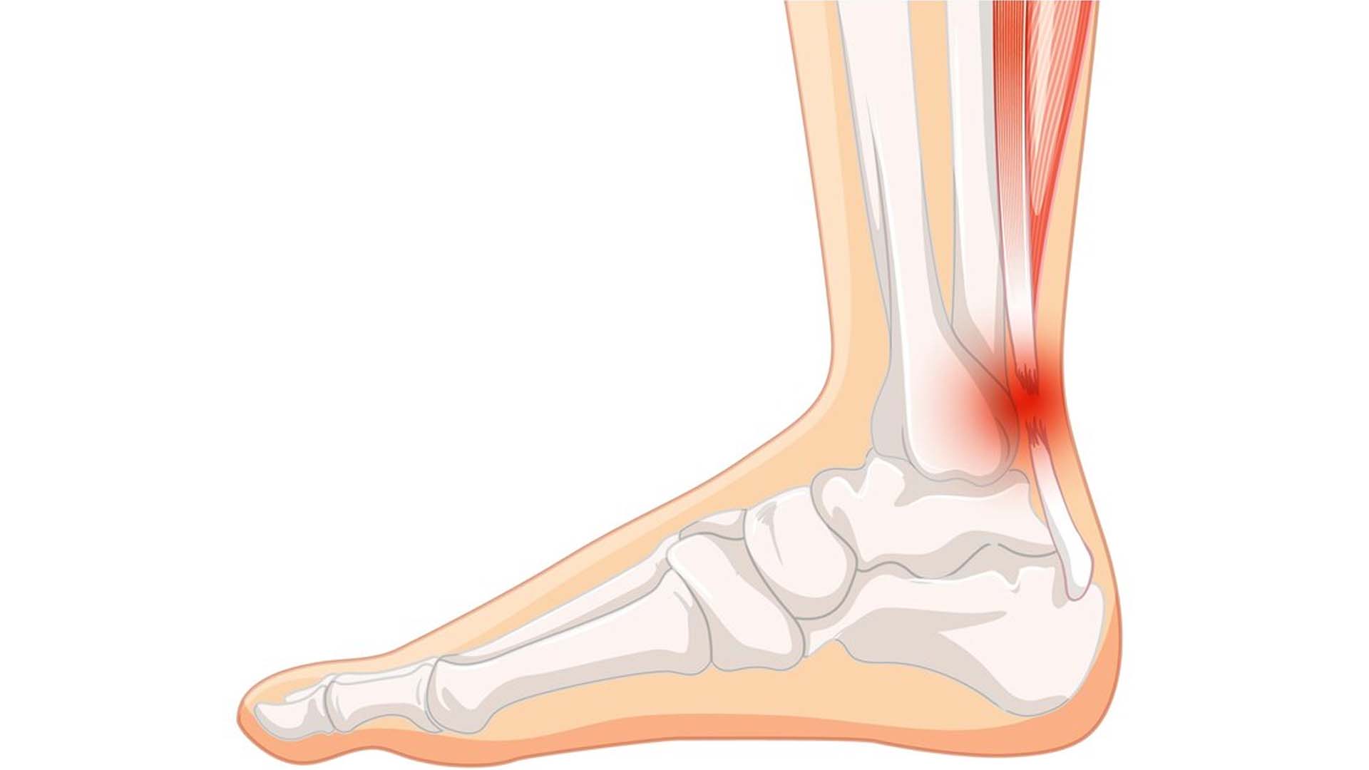 Achilles Tendonitis