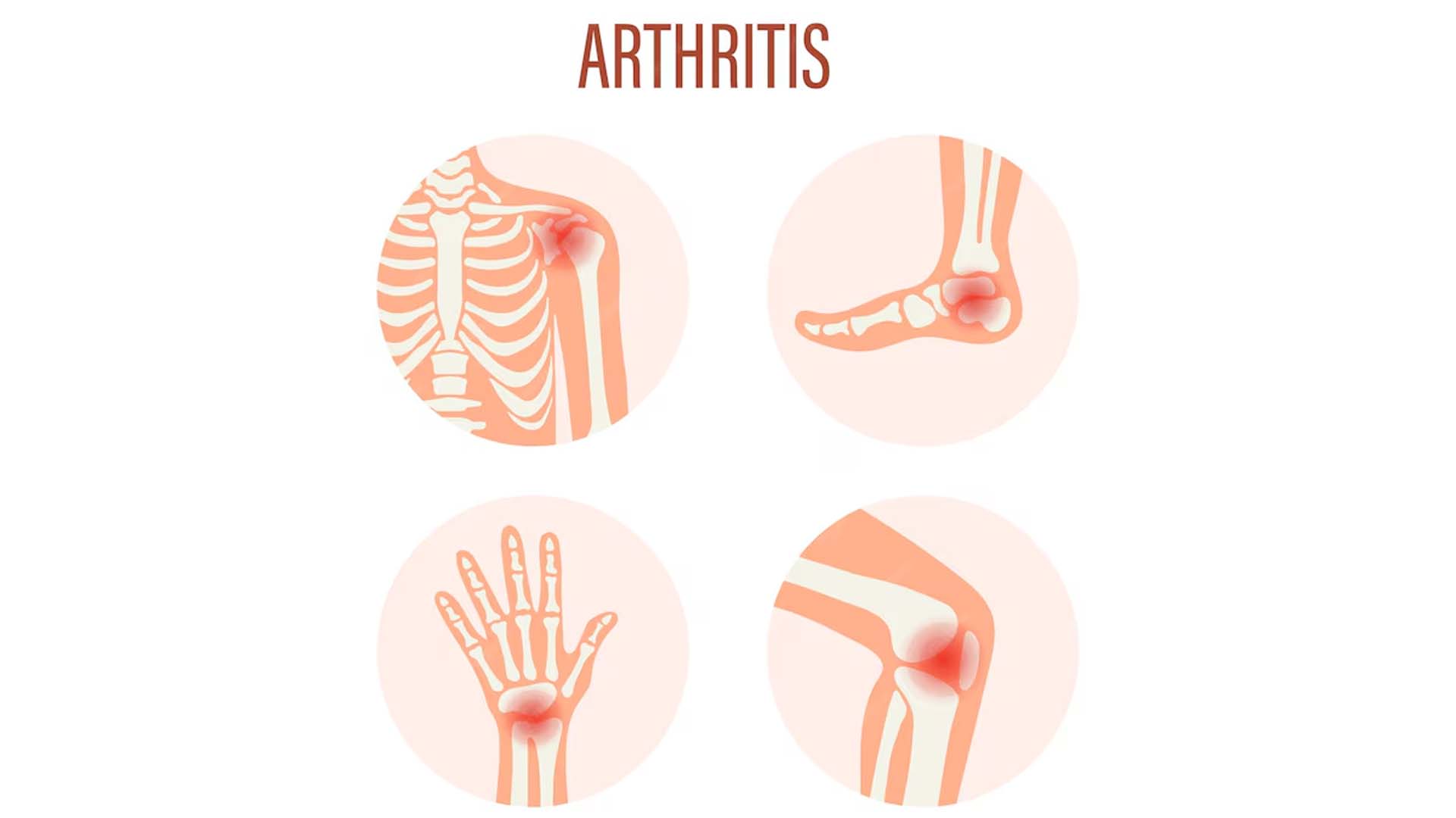 Arthritis