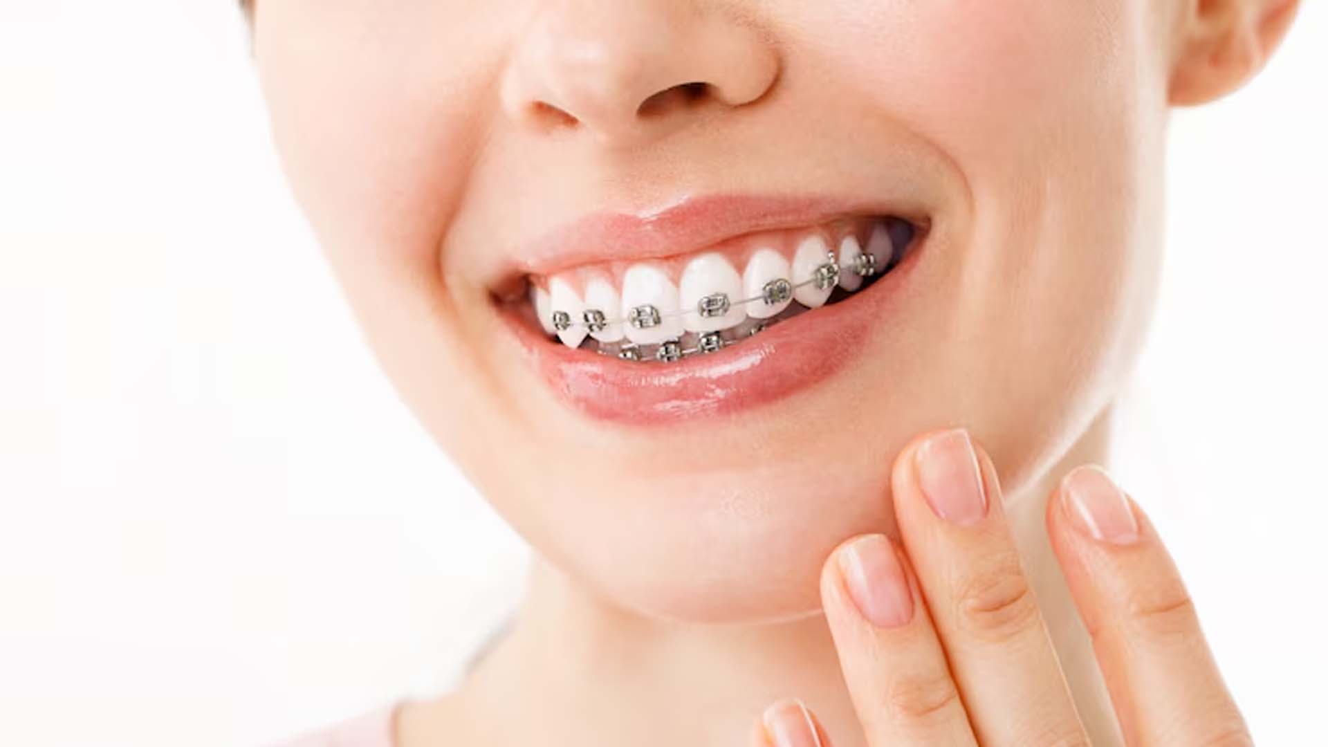 Women Wearing Braces