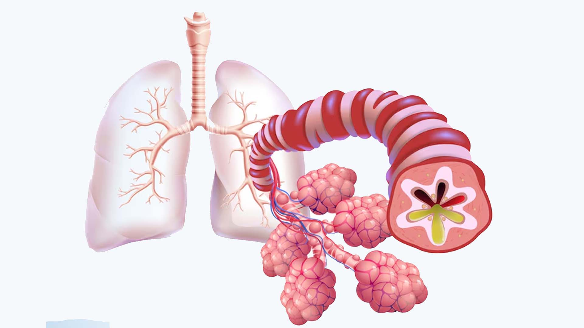 Bronchitis