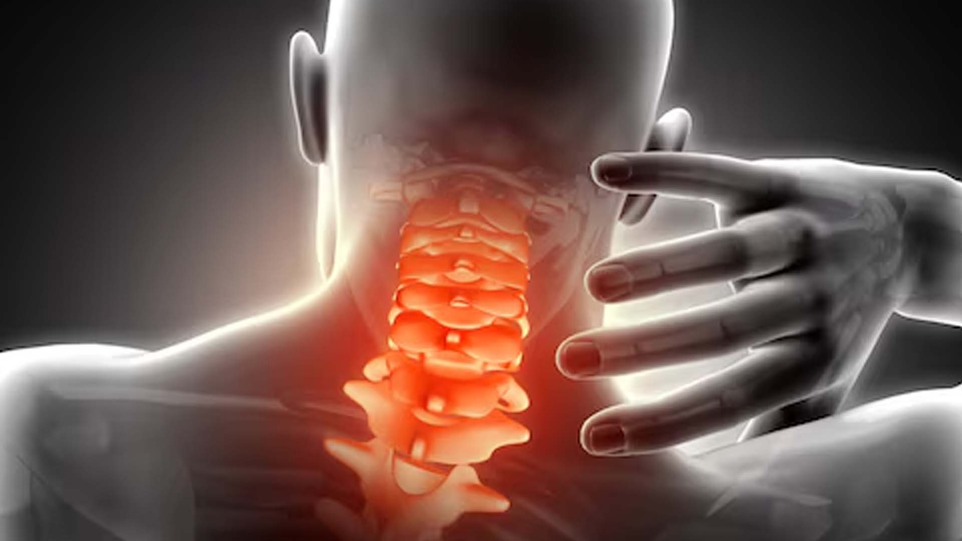 Cervical Spondylosis