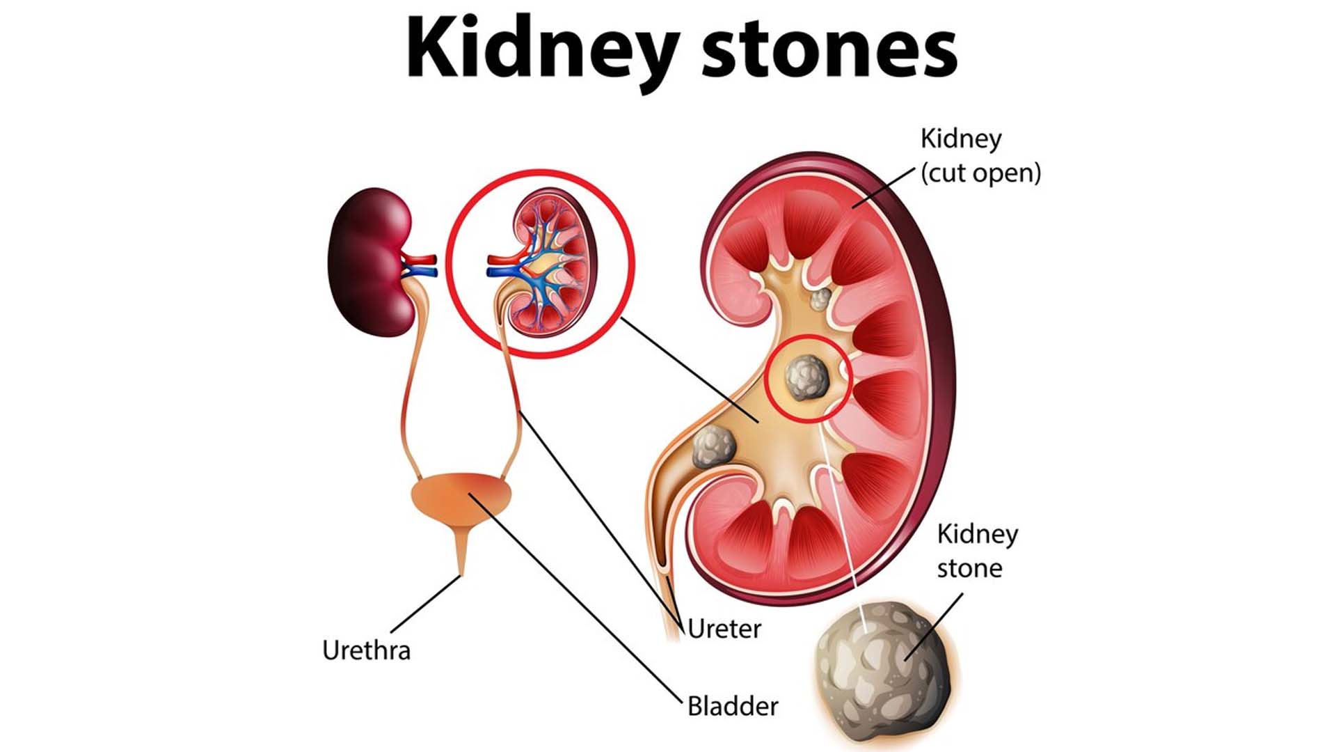 Kidney Stones