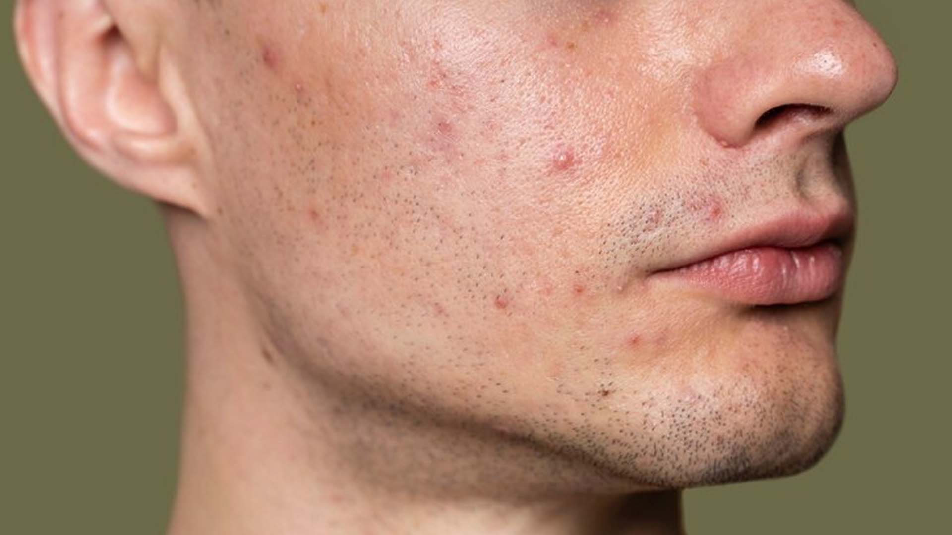 Acne Breakouts in Man