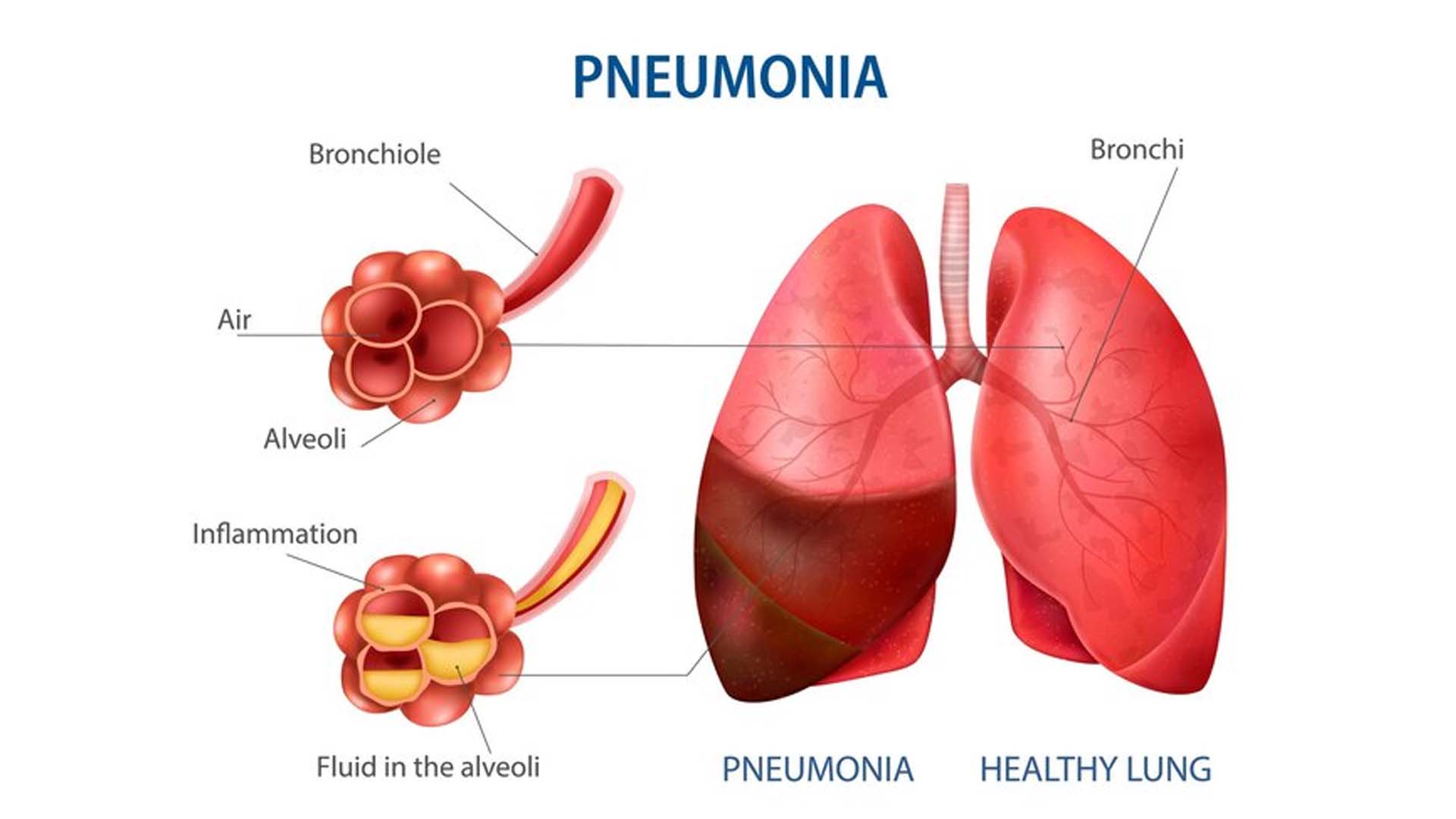 Pneumonia