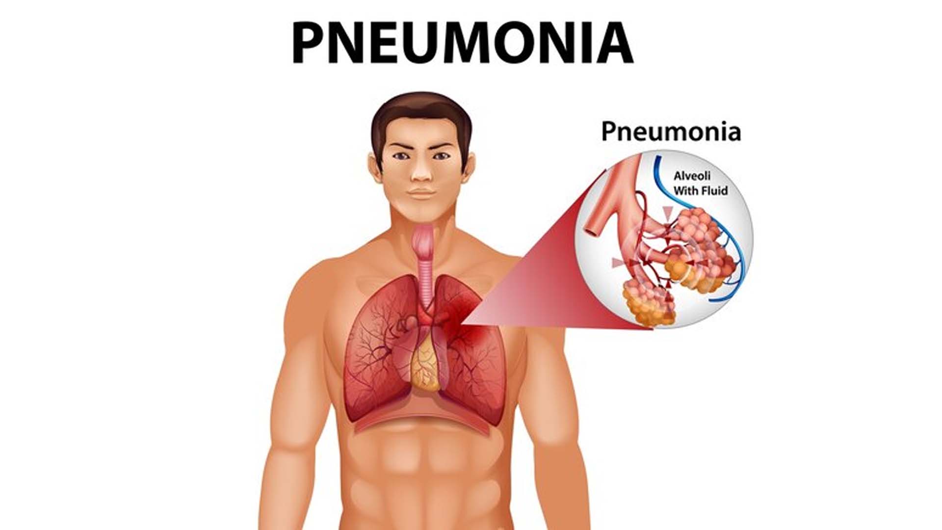 Pneumonia